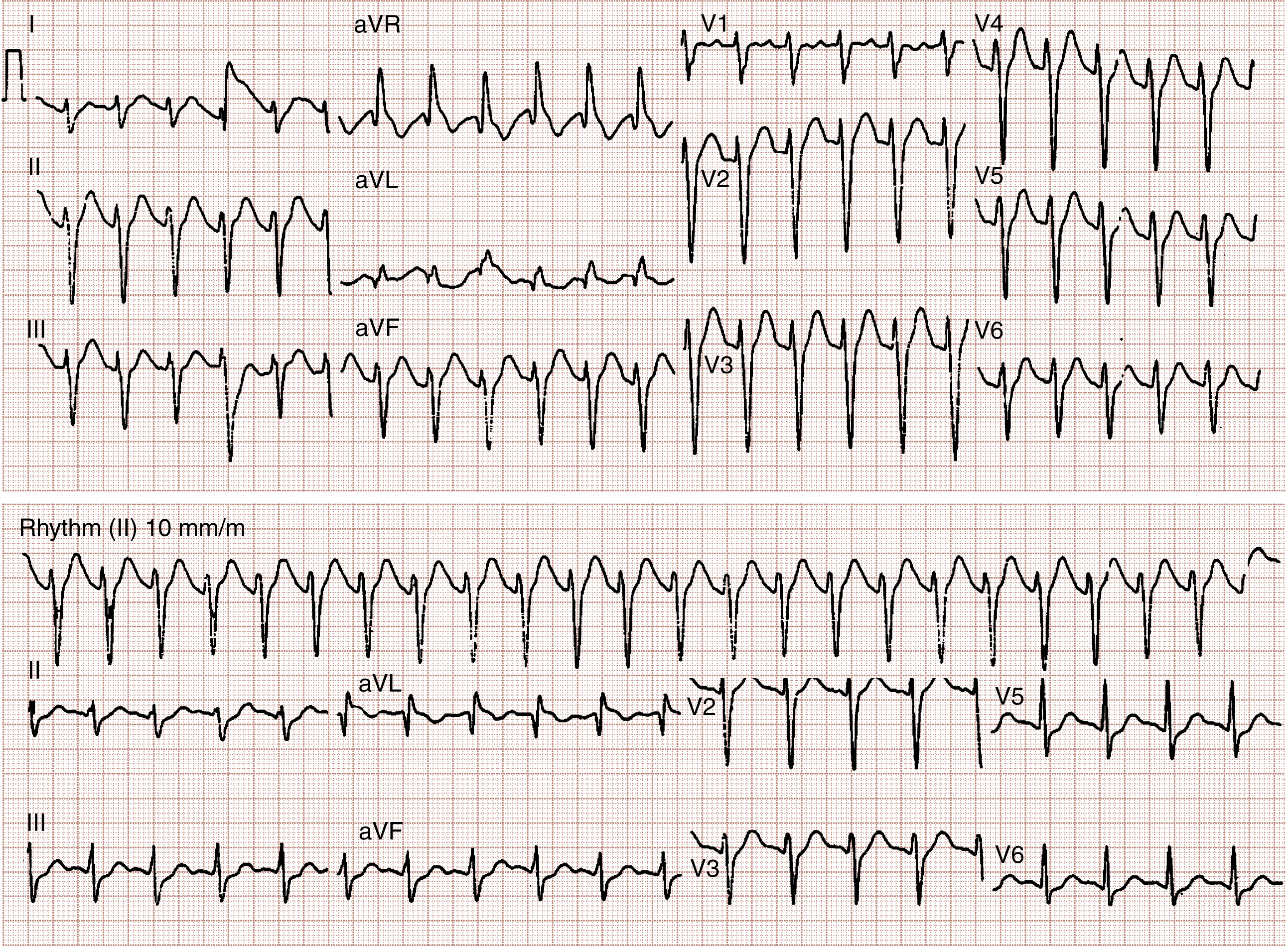 The ECG shows two 12-lead: top shows intraventricular conduction delay with wide QRS 141 ms in leads aVR, aVL, aVF, V1–V6; bottom after bicarbonate therapy shows improved narrower QRS. The ECG shows two 12-lead. The top ECG demonstrates substantial intraventricular conduction delay with a QRS duration of 141 milliseconds, including leads aVR, aVL, aVF, V1, V2, V3, V4, V5, and V6. The bottom ECG, recorded after bicarbonate therapy, shows improved conduction with narrower QRS complexes. Both ECGs are displayed on standard grid paper labeled Rhythm II at 10 millimeters per millivolt.