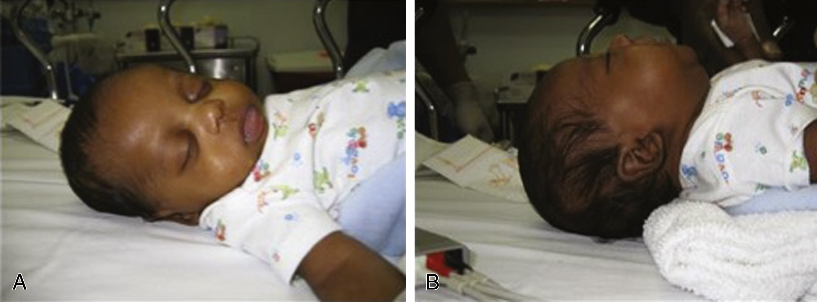 A set of two photograph shows A and B. A shows neck flexed with head tilted forward, B shows a shoulder roll placed, positioning the neck in neutral or extended alignment. A set of two photograph shows A and B. A shows the infant’s neck is flexed with the head tilted forward. B shows a roll is placed under the shoulders, positioning the neck in a neutral or extended alignment, improving airway posture.