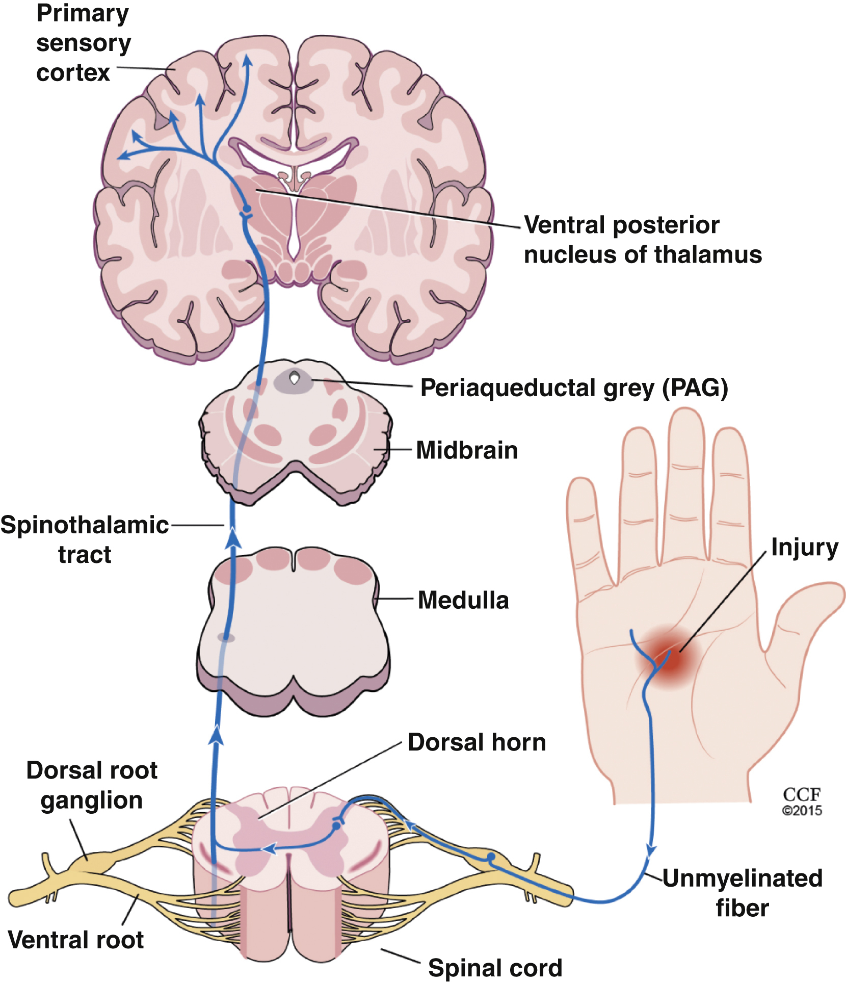 The diagram shows the pain pathway injury signal traveling via unmyelinated fiber to dorsal root ganglion, dorsal horn, spinothalamic tract, medulla, PAG, thalamus, and primary sensory cortex. The diagram shows the pain pathway beginning at an injury on the hand, where an unmyelinated fiber transmits the signal to the spinal cord through the dorsal root ganglion and ventral root. The signal enters the dorsal horn and travels upward through the spinothalamic tract, passing through the medulla and midbrain to reach the periaqueductal grey labeled PAG. From there, the pathway continues to the ventral posterior nucleus of the thalamus and then projects to the primary sensory cortex of the brain, where pain perception occurs.