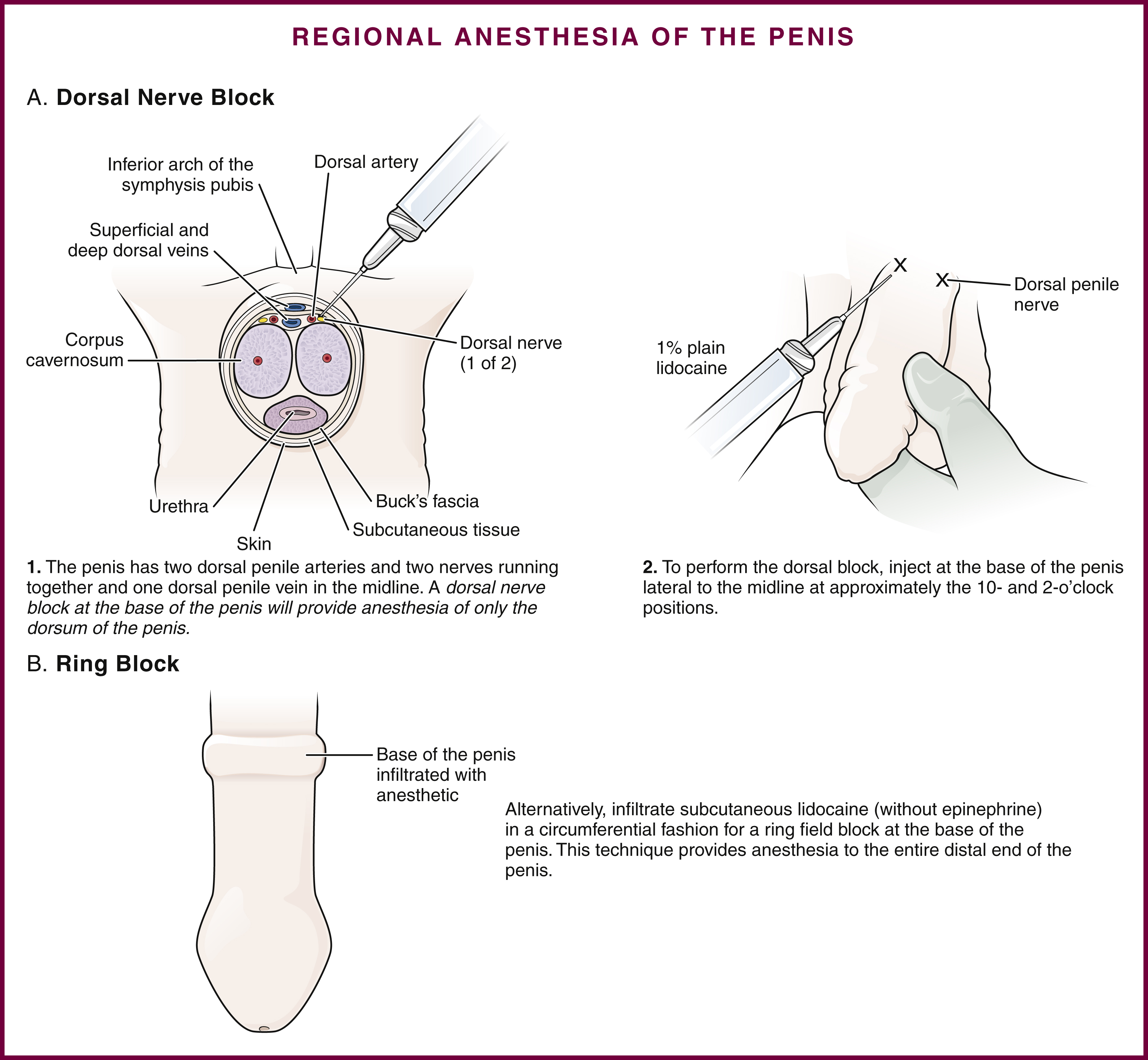 The diagram shows penile anesthesia, dorsal nerve block injects lidocaine at base near dorsal nerves for dorsum anesthesia; ring block infiltrates lidocaine around base for full distal anesthesia. The diagram titled “REGIONAL ANESTHESIA OF THE PENIS” illustrates two techniques, a dorsal nerve block and a ring block. Part A, “Dorsal Nerve Block,” shows two cross-sectional views of the penis. The first, labeled “1,” depicts the anatomy including the inferior arch of the symphysis pubis, dorsal artery, superficial and deep dorsal veins, corpus cavernosum, urethra, Buck's fascia, subcutaneous tissue, skin, and dorsal nerve (1 of 2), with text stating that the penis has two dorsal penile arteries and two nerves running together and one dorsal penile vein in the midline, and that a dorsal nerve block at the base of the penis provides anesthesia of only the dorsum of the penis. The second, labeled “2,” shows a hand injecting 1% plain lidocaine near the dorsal penile nerve, with text explaining to inject at the base of the penis lateral to the midline at approximately the 10- and 2-o'clock positions to perform the dorsal block. Part B, “Ring Block,” shows a longitudinal view of the penis with an arrow pointing to “Base of the penis infiltrated with anesthetic,” and accompanying text explaining to infiltrate subcutaneous lidocaine (without epinephrine) in a circumferential fashion for a ring field block at the base of the penis, noting that this technique provides anesthesia to the entire distal end of the penis.