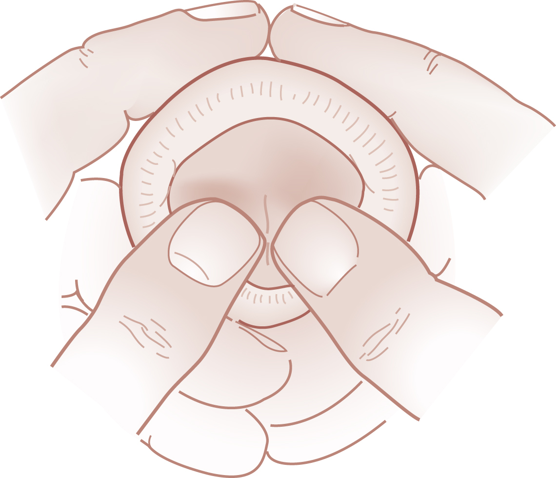 The illustration shows a pair of hands performing paraphimosis reduction, with thumbs pressing the glans and fingers retracting the foreskin, as viewed from the distal end of the penis.
