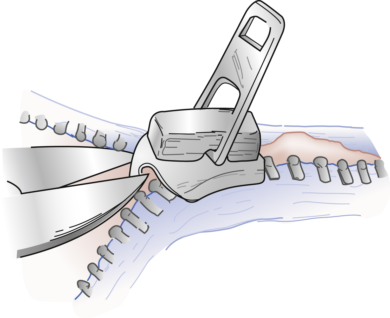The photograph shows zipper entrapment release by cutting the central bar of the zipper slider with pliers, freeing the trapped tissue and allowing the zipper teeth to separate. The photograph shows a technique for releasing zipper entrapment by cutting the median bar of the zipper. A pair of pliers or cutters is shown precisely severing the central metal bar of the zipper slider, which is entrapping tissue, allowing for the disengagement of the zipper teeth and release of the trapped skin.