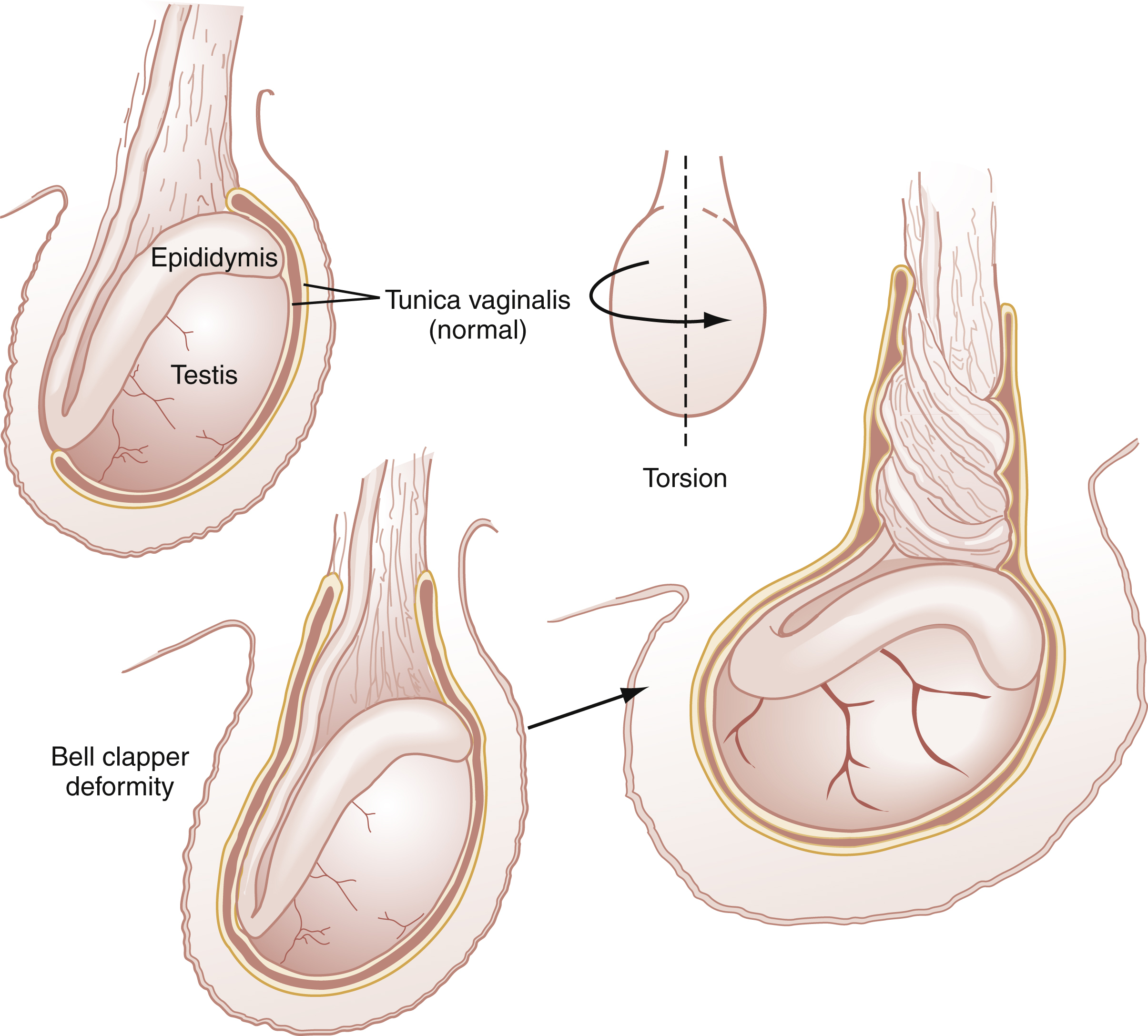 The diagram shows normal testis suspension and bell clapper deformity, which allows free hanging and predisposes to torsion, shown with a twisted spermatic cord from testicular rotation. The diagram shows the anatomy of testicular torsion, contrasting normal testicular suspension with conditions that predispose to torsion. The top left diagram shows a normal testis and epididymis within the scrotum, labeled “Tunica vaginalis (normal).” To its right, an arrow showing a motion labeled “Torsion,” demonstrating how the testis can rotate on its axis. Below the normal anatomy, the bottom left diagram illustrates a “Bell clapper deformity,” where the testis lacks proper attachment to the scrotal wall, allowing it to hang freely and thus predisposing it to torsion. An arrow points from this deformity to the detailed diagram on the bottom right, which shows a severely twisted spermatic cord, resulting from torsion of a testicle with a bell clapper deformity.