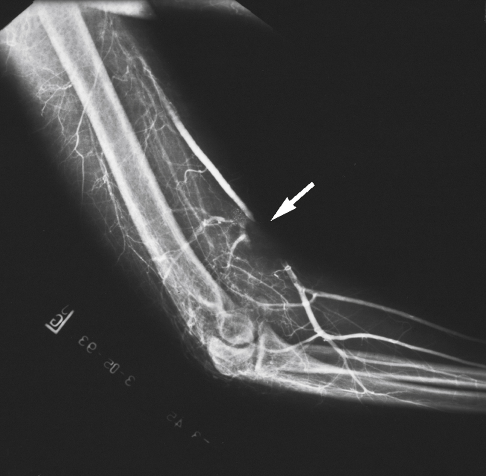 Angiogram view shows distal brachial artery thrombosis with sharp contrast cutoff near elbow, minimal flow seen in forearm arteries beyond blockage.