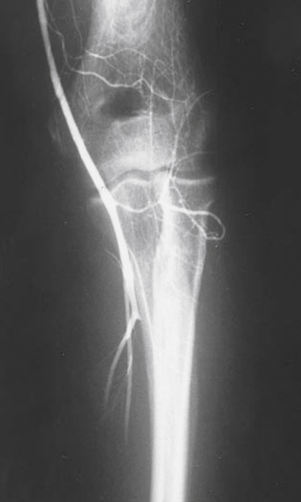 Angiogram view of an arm shows brachial artery narrowing and irregularity near elbow, showing acute arterial spasm from inadvertent intra-arterial injection.