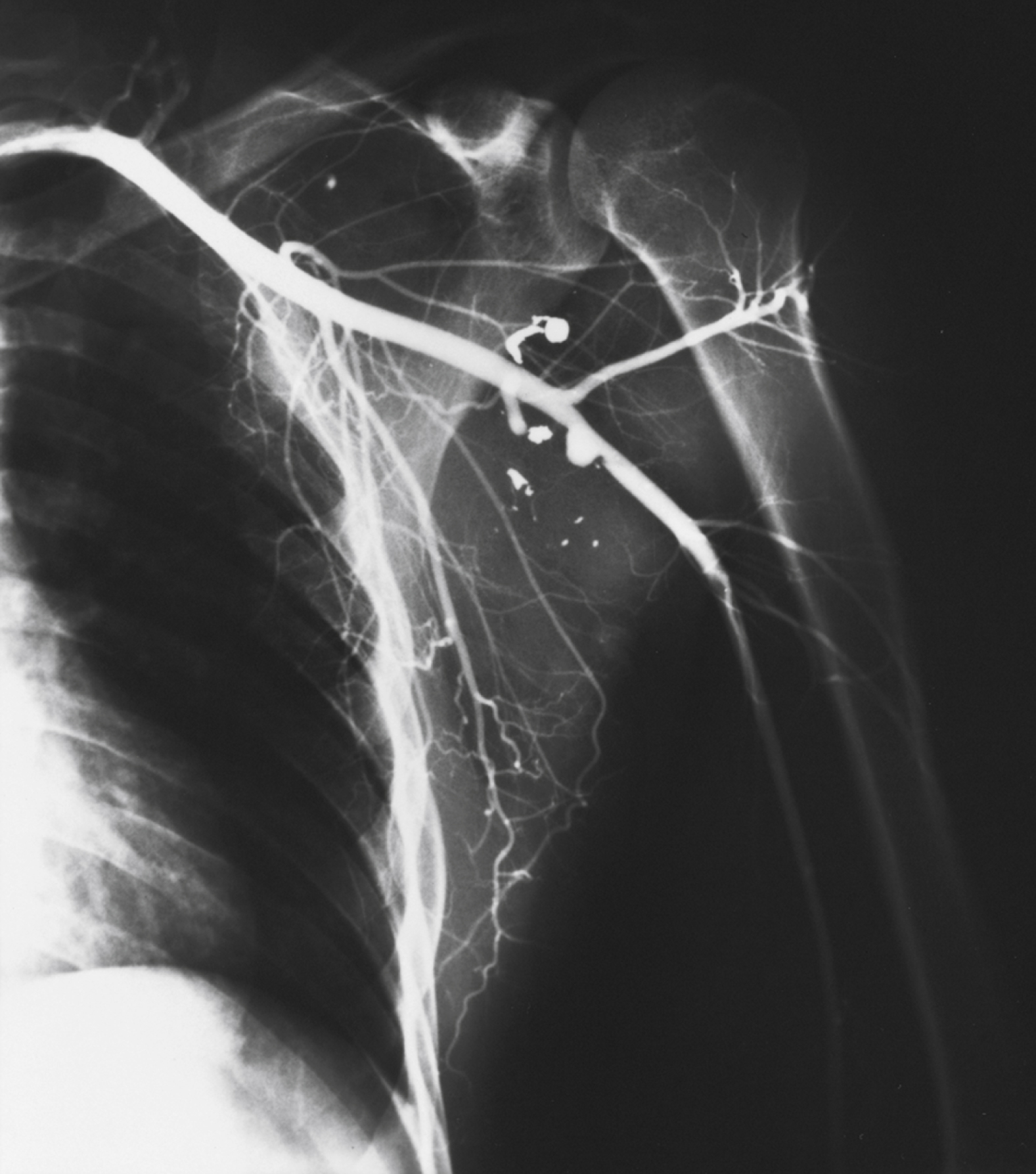 Angiogram view of the shoulder and upper arm shows axillary artery with multiple small pseudoaneurysms as sac dilatations along branches, from penetrating trauma.