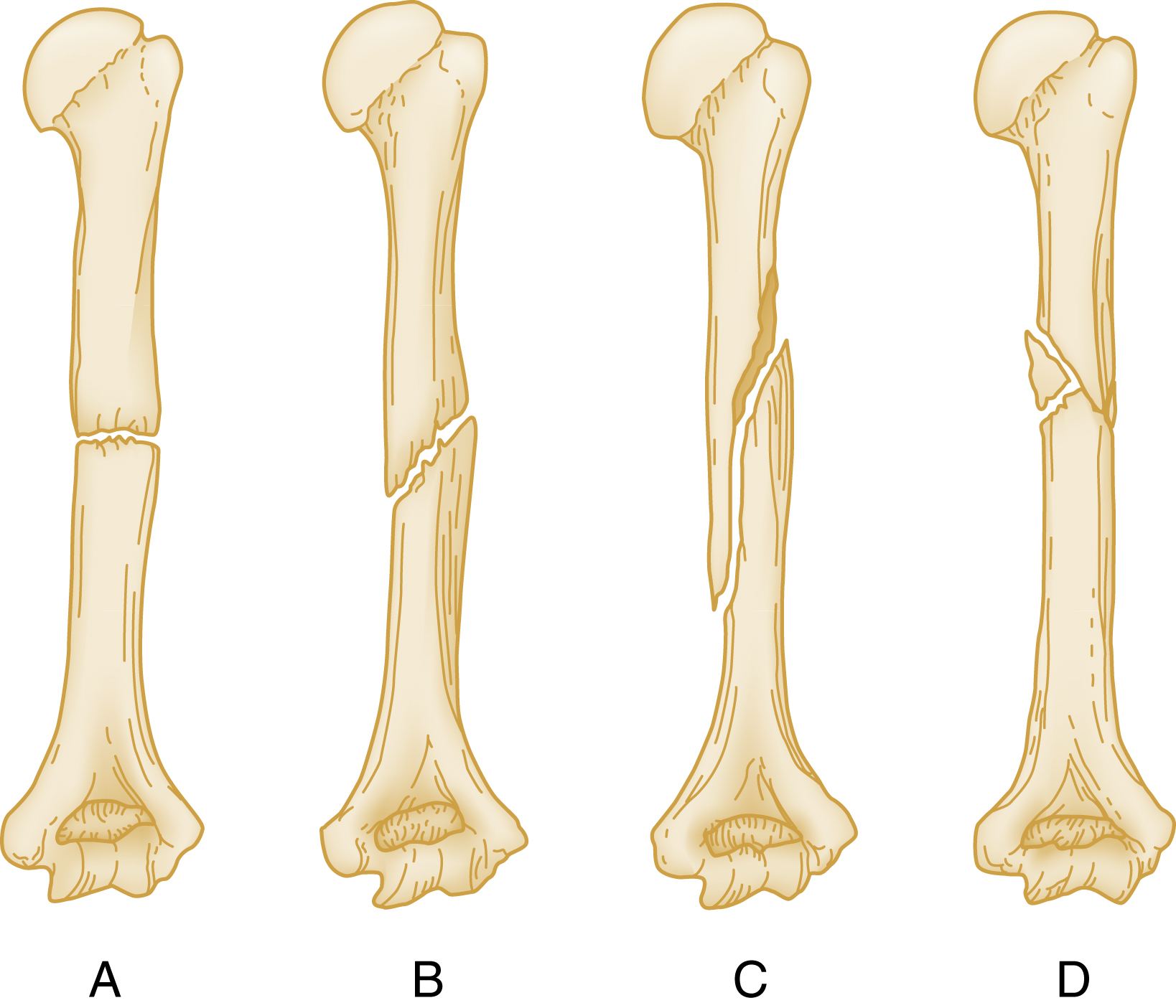 A set of four panels (A to D) illustrating bone fractures. A, transverse with horizontal break. B, oblique with diagonal break. C, spiral from twisting. D, comminuted with shattered bone. A set of four panels (A to D) illustrating bone fractures. A depicts a transverse fracture with a horizontal break across the bone. B shows an oblique fracture with a diagonal break. C illustrates a spiral fracture caused by a twisting force. and D shows a comminuted fracture with the bone shattered into multiple fragments.