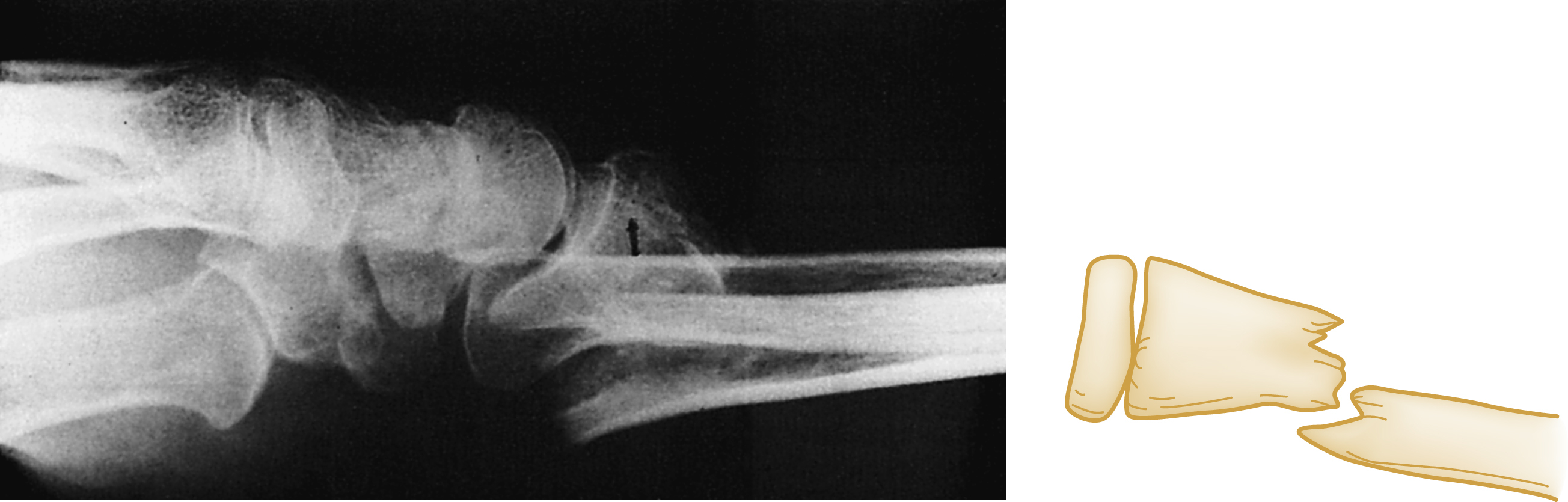 A set of two panels show a lateral wrist X-ray and illustration of a distal radius fracture with dorsal displacement, showing backward shift from a fall on an outstretched hand. A set of two panels shows a lateral wrist X-ray and a matching anatomical illustration, both displaying a distal radius fracture with dorsal displacement. The distal bone fragment is shifted backward toward the dorsal side of the wrist. The illustration shows the jagged break and misalignment, a typical result of a fall on an outstretched hand causing upward and backward displacement.