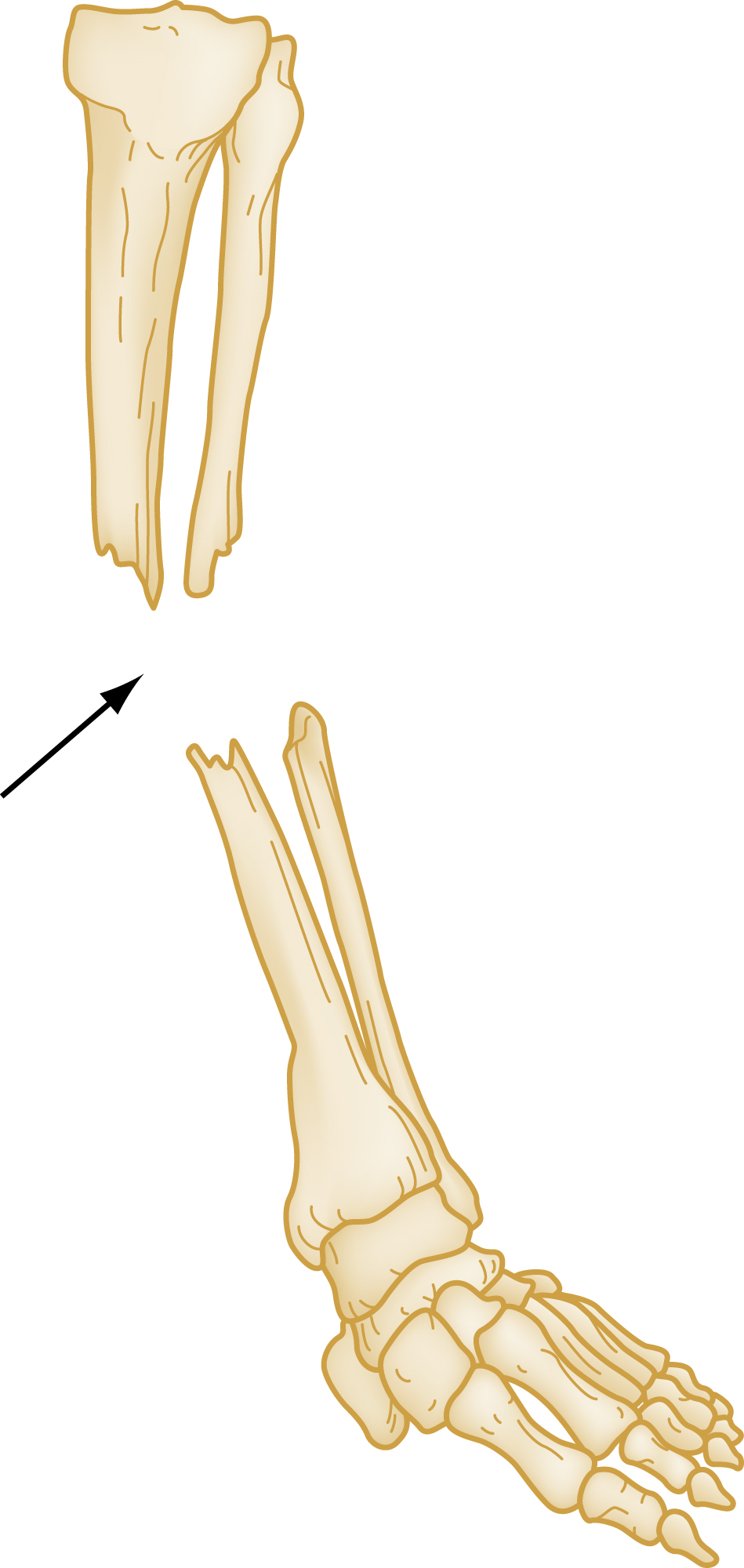 The diagram shows the fracture is located near the ankle, with the distal segment angling outward, away from the body's midline. An arrow points to the fracture site, shows the separation of bones.