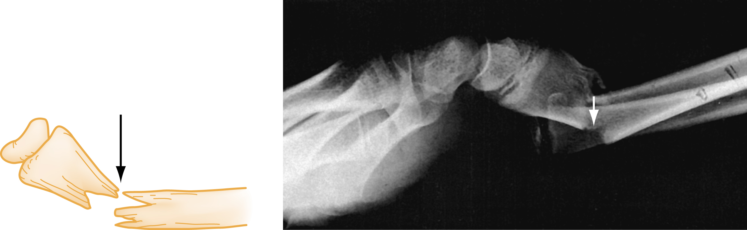 A set of two panel illustrates volar angulation of a fractured radius. Left, an illustration with a black arrow shows volar ben. Right, a lateral X-ray with a white arrow marks the fracture site. A set of two panel illustrates volar angulation of a fractured radius. On the left, illustration shows a fractured radius with the distal bone segment bent toward the volar side (palm) and a black downward arrow shows the direction of displacement. On the right, a lateral X-ray of the wrist shows the same injury, with a white arrow pointing to the fracture site where the distal fragment is angulated toward the palm.