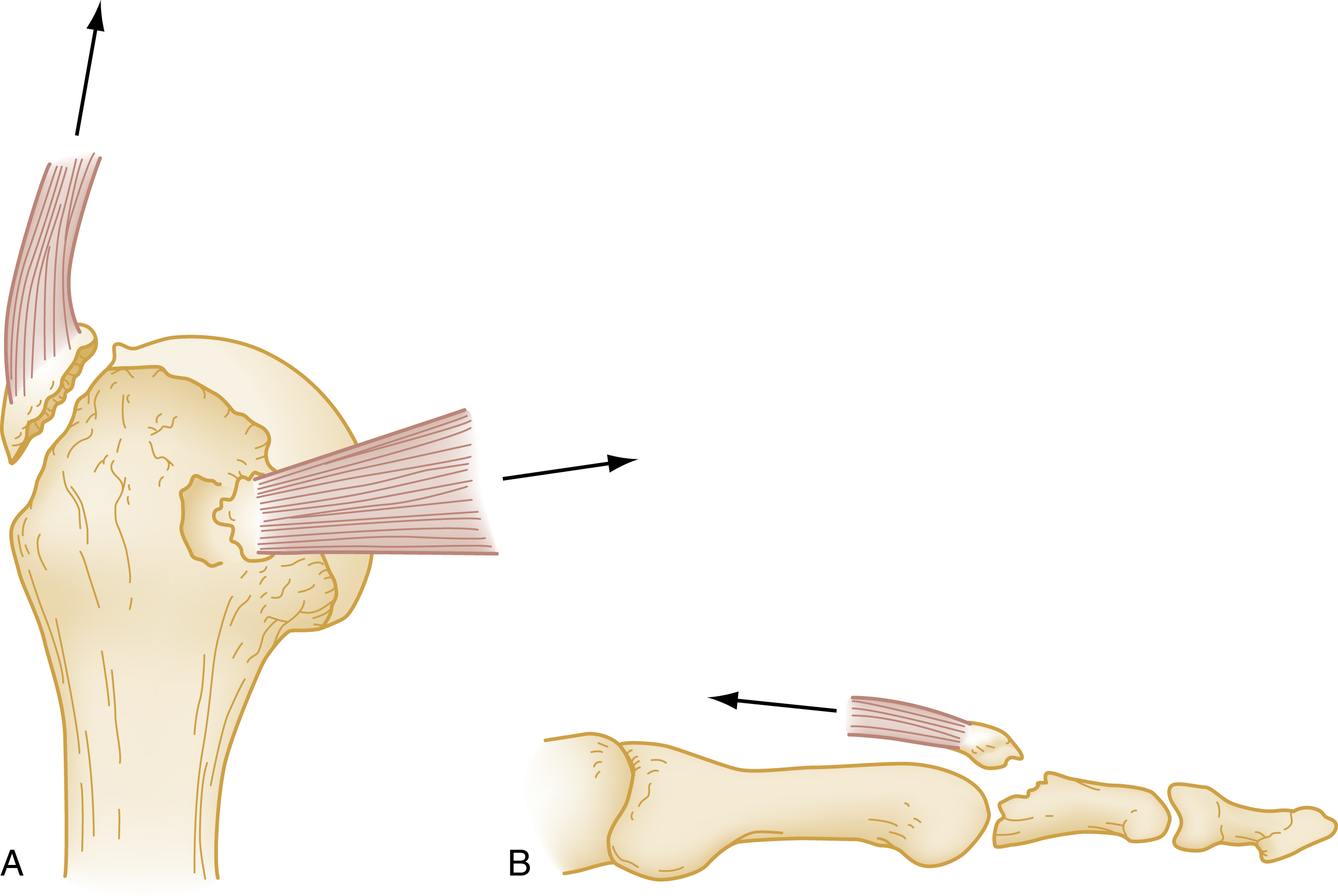 The illustration shows two panel A and B. A, muscle pulls bone fragments from humerus head (arrows show force). B, tendon pulls bone from base of middle phalanx (arrow shows force). The illustration shows two panel A and B. Panel A depicts the proximal humerus with musculotendinous avulsions, where small bone fragments are pulled away from the head of the humerus. Arrows shows the direction of force from the attached muscles causing the avulsion. Panel B shows a finger with an extensor tendon avulsion, where a fragment of bone is pulled from the base of the middle phalanx. An arrow shows the direction of the tendon force that resulted in the fracture.