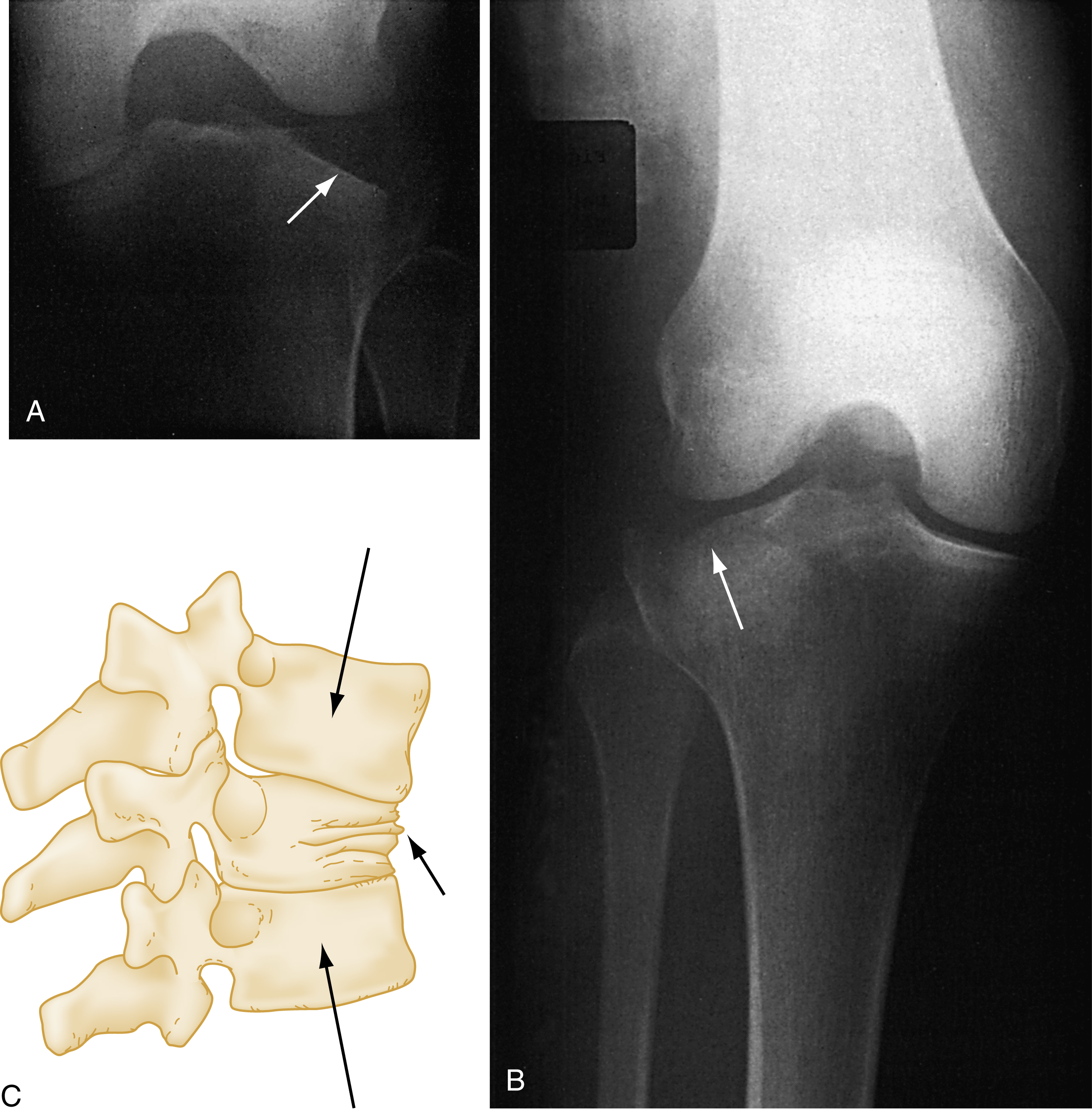A set of three panels A to C. A shows lateral tibial plateau fracture (arrow). B shows medial tibial plateau fracture (arrow). C illustrates vertebral body compression (three arrows). A set of three panels A to C. Panel A is an X-ray of a tibial plateau fracture with an arrow pointing to the fracture line on the lateral aspect of the tibia. Panel B is another X-ray showing a frontal view of the knee with an arrow shows the tibial plateau fracture on the medial side. Panel C is illustration of the spine showing a vertebral body compression fracture, with three arrows pointing to the compressed vertebral body and surrounding vertebrae.