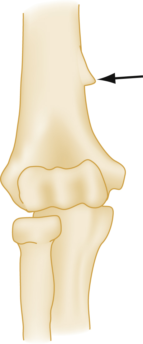 The illustration shows anterior view of right elbow, distal humerus with radius and ulna, black arrow points to bony spur on medial side above medial epicondyle, called supracondylar process.