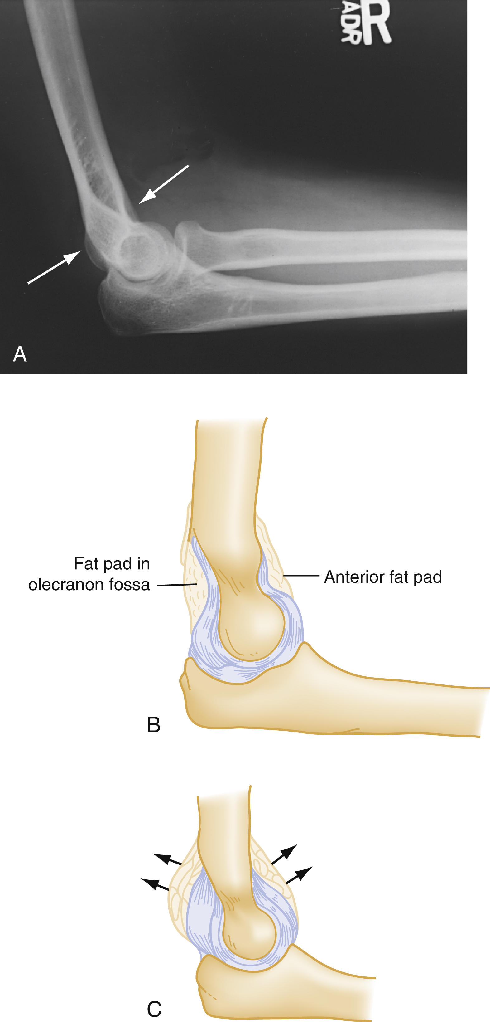 The three panels illustrating lateral X-ray with displaced fat pads from effusion, B shows normal anterior and hidden posterior fat pads, C shows effusion pushing both fat pads. The three panels illustrating the concept of elbow fat pads in relation to joint effusions. panels A is a lateral X-ray of an elbow, with two white arrows pointing to radiolucent areas representing displaced fat pads, displaying an effusion. panels B shows a normal elbow joint, the anterior fat pad as a thin strip anterior to the humerus and the posterior fat pad located within the olecranon fossa, normally not visible. panels C, another anatomical diagram, depicts an elbow with an effusion. Black arrows point away from the joint, demonstrating how the effusion displaces both the anterior and posterior fat pads, making the normally unseen posterior fat pad now visible and elevating the anterior fat pad.