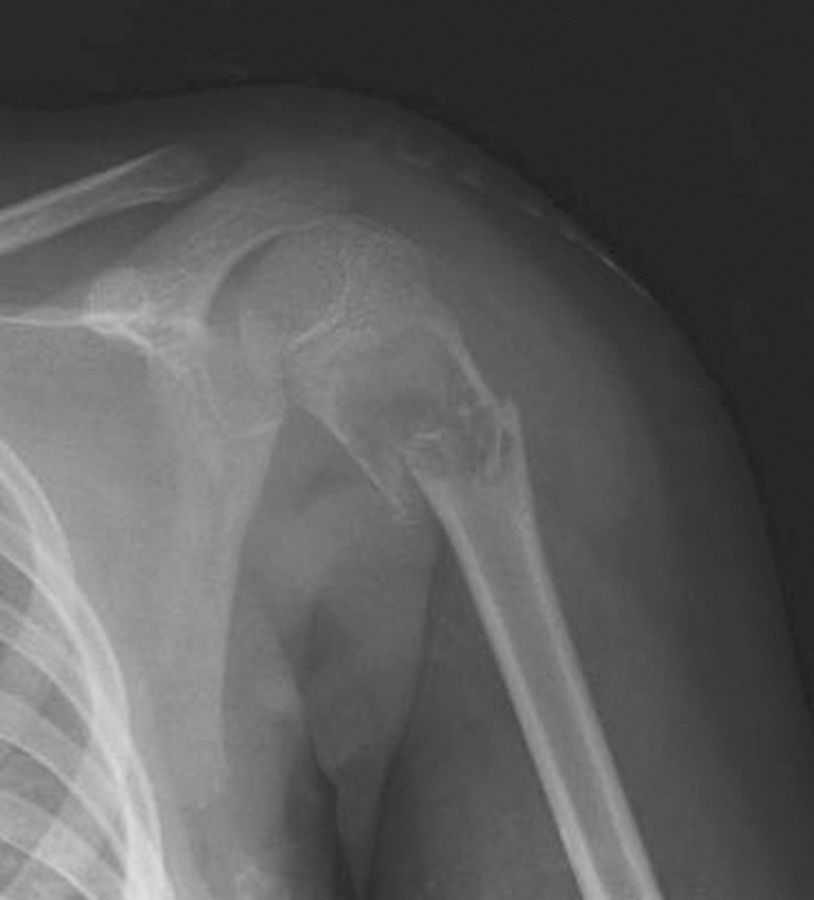 The X-ray shows proximal humerus fracture with irregular break and reduced bone density at upper shaft, shows fracture through diseased bone rather than healthy bone trauma.