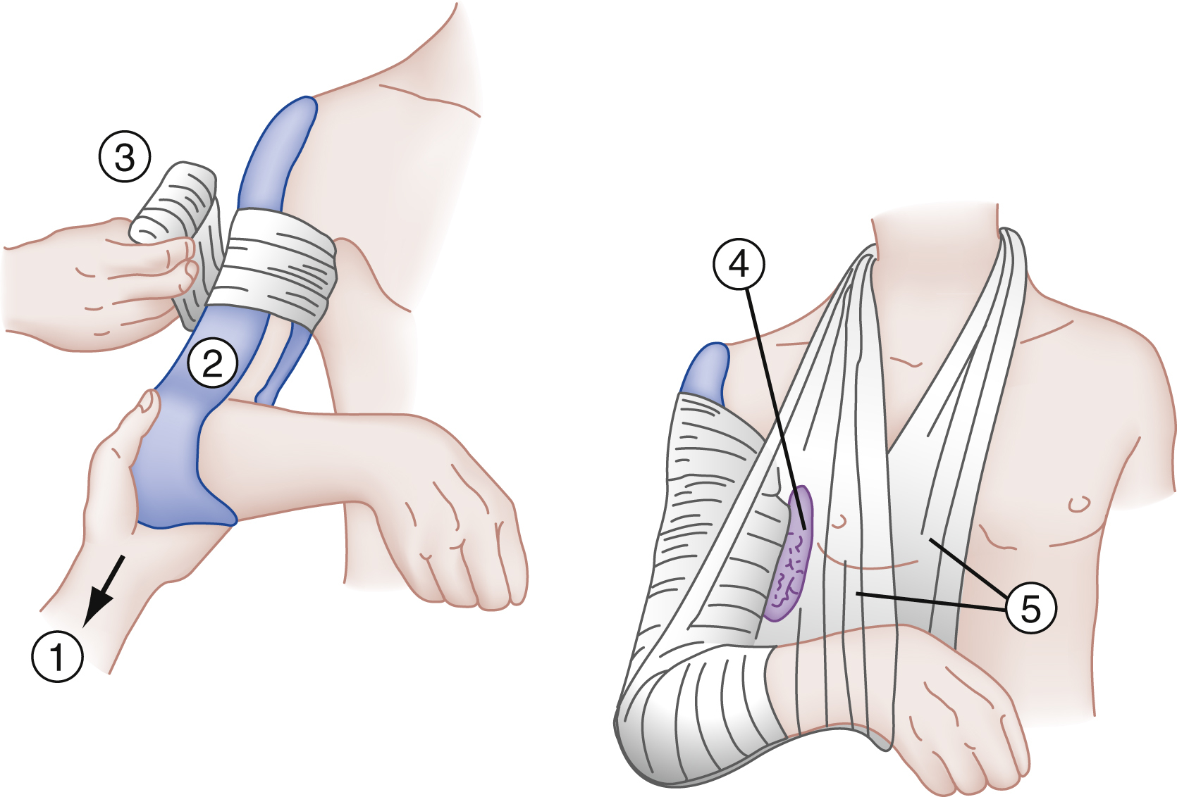 The illustration shows sugar tong splint for humeral shaft fracture, left panel shows traction, U-shaped splint, elastic wrap, right panel shows padded axilla and sling supporting arm. The illustration shows the application of a sugar-tong splint for humeral shaft fractures, presented in two sequential steps. The left panel shows the initial application, where gentle traction is applied to the forearm (1). A U-shaped splint (2) is being placed, extending from over the deltoid laterally, curving around the elbow, and continuing up into the axilla. An elastic wrap (3) is being applied to hold the splint in place. The right panel depicts the completed splint application. The axilla is showsn to be padded (4) to prevent pressure, and the arm is supported in a sling (5) that holds the spl forearm and injured humerus in a secure position against the body.