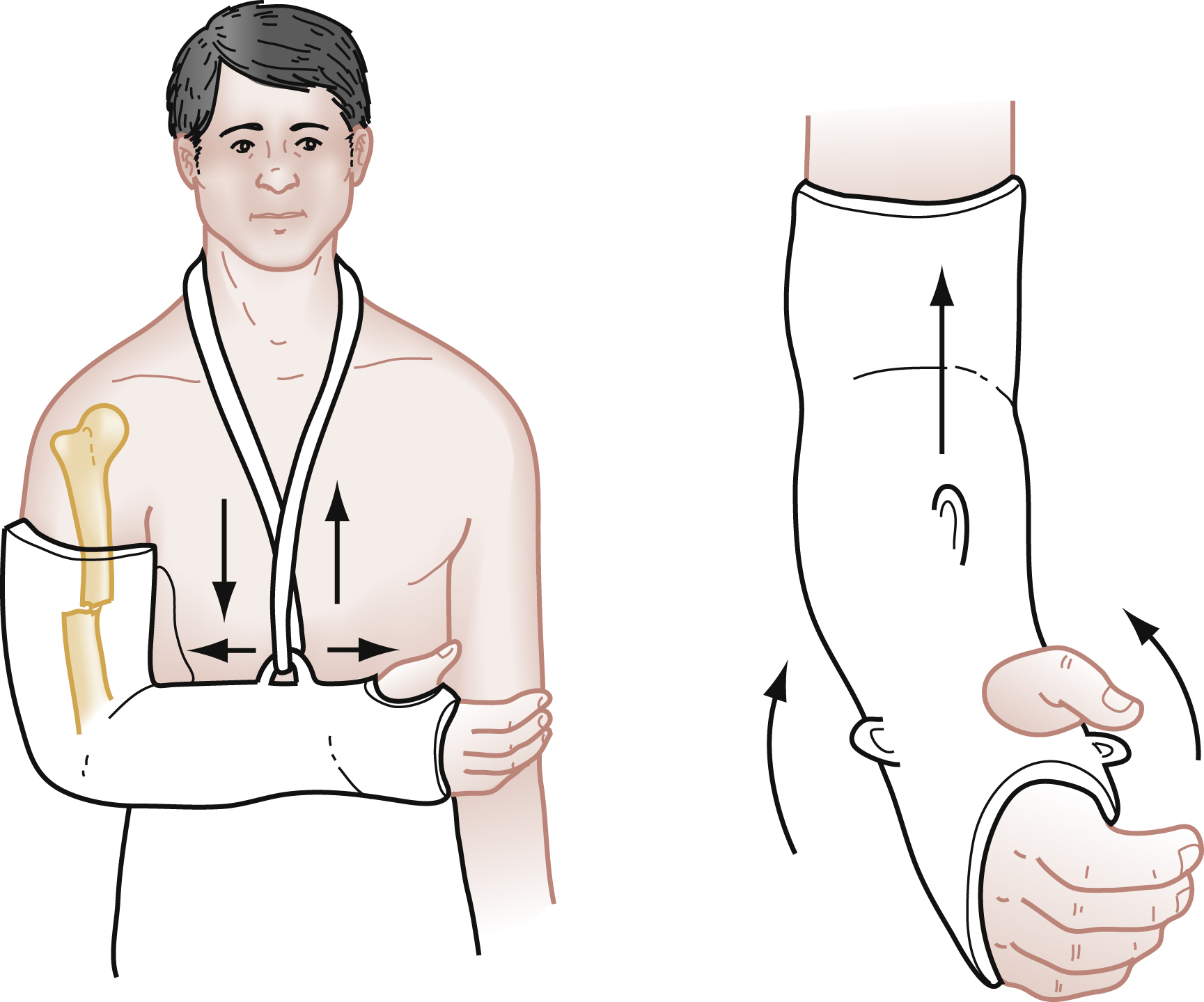 The illustration shows hanging cast for humeral shaft fracture, left side shows arm in cast with gravity pulling down and sling pulling up, right side shows close view of rotation forces. The illustration shows the “Hanging Cast Technique” for managing an arm fracture, depicted in two parts. The left side shows a male figure with his right arm in a hanging cast and sling. The humerus bone is visible through the cast, showsing a fracture in its shaft. Arrows shows the forces at play, downward arrows on the cast and forearm representing the effect of gravity, and upward arrows on the shoulder and chest from the sling, which maintains traction on the fractured humerus. The right side of the illustrates provides a closer view of the hanging cast on the forearm and hand. Arrows on this detailed view shows the upward traction force exerted by the cast's weight and the sling, and the rotational forces on the forearm as the cast helps align the fracture.