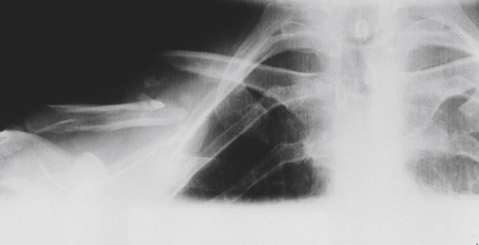 The X-ray shows a displaced midclavicular fracture, showing a clear break and misalignment in the middle portion of the collarbone.