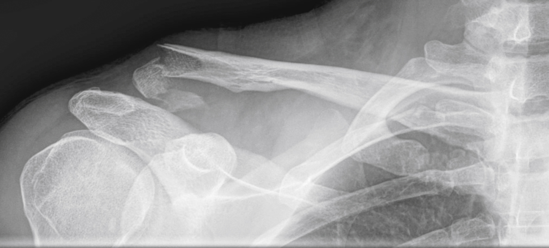 The X-ray of a shoulder shows a Type II lateral clavicular fracture, where the outer end of the collarbone is broken and displaced, showsing a torn coracoclavicular ligament.
