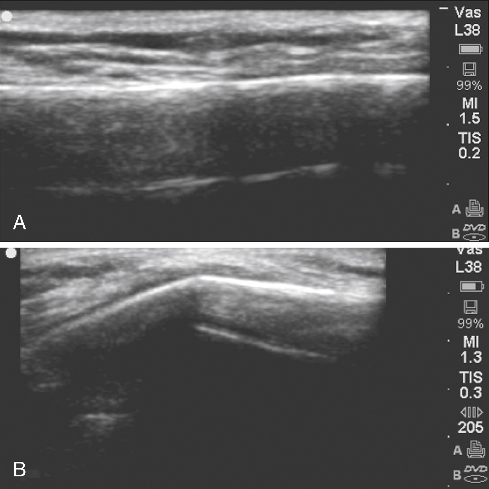 The set of two Ultrasound A and B shows the clavicle are presented. A shows a normal, smooth bone surface, B shows a midclavicular fracture with a visible discontinuity and step-off in the bone. The set of two Ultrasound A and B shows the clavicle are presented. A shows a normal clavicle with a smooth, continuous bone surface, while B shows a midclavicular fracture, evident by a clear discontinuity and step-off in the bone structure.