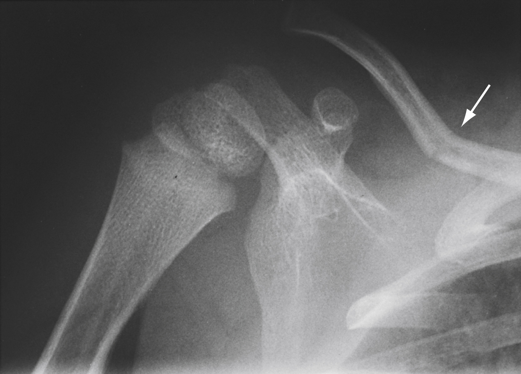 The X-ray shows a greenstick fracture of the clavicle, showed by a white arrow pointing to a subtle bend and incomplete break in the bone, located in the upper right portion.