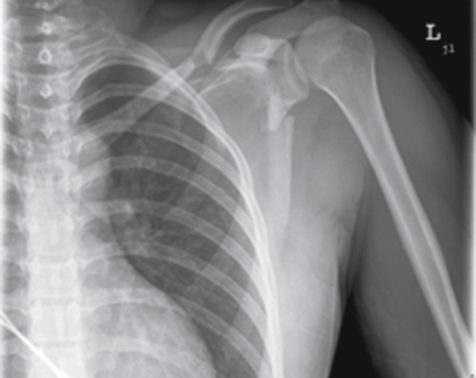 The X-ray of a left shoulder and upper torso reveals an extra-articular fracture involving the neck of the scapula, visible as a distinct break in the bone connecting the shoulder blade to the arm.