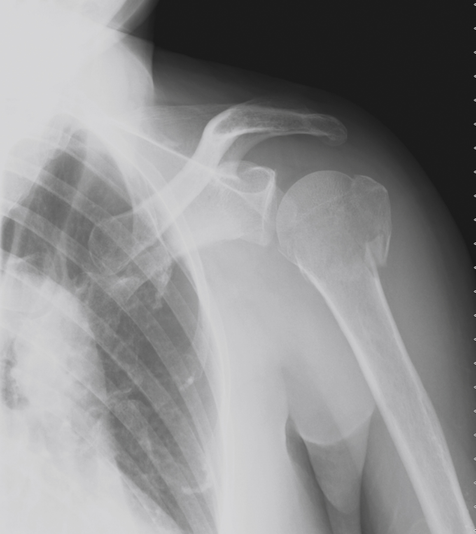 The X-ray of a shoulder, shows a three-part minimally displaced fracture of the proximal humerus. The fracture involves both the greater and lesser tuberosities.