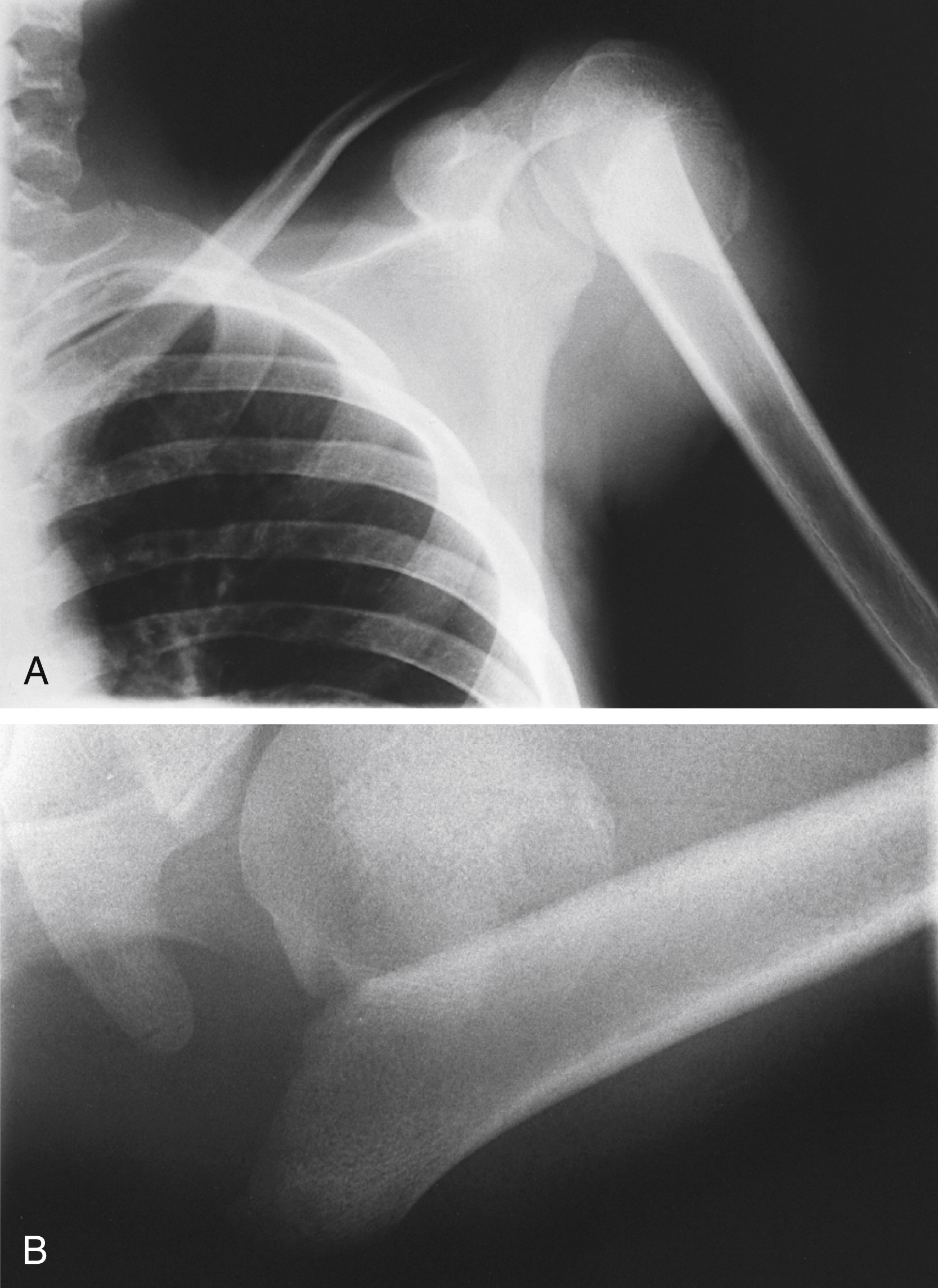 A set of two X-rays A and B show a two-part displaced proximal humerus fracture, A is anteroposterior view, B is axillary view showing extent of displacement. A set of two X-ray A and B shows two-part displaced fracture of the proximal humerus. A, shows an anteroposterior view of the shoulder and upper arm, revealing the displacement of the humeral head from the shaft. B, shows an axillary view, offering an alternative perspective that better highlights the degree of the fracture displacement in the proximal humerus.