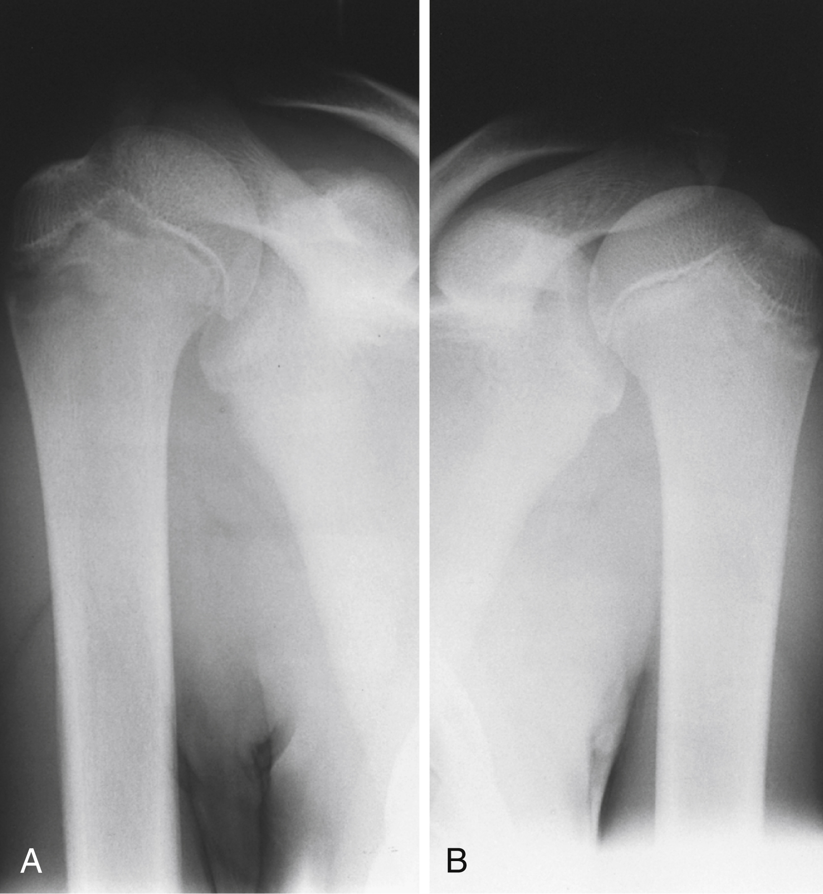 The X-ray shows set of Two panel A and B. A shows right Salter I fracture of proximal humeral epiphysis with widened growth plate, B shows normal left shoulder with regular growth plate. The X-ray shows set of Two panel A and B. A shows a right shoulder with a Salter I injury of the proximal humeral epiphysis, showed by a widened and irregular growth plate at the top of the humerus. B provides a normal left shoulder for comparison, exhibiting a clean and well-defined growth plate in the same region.