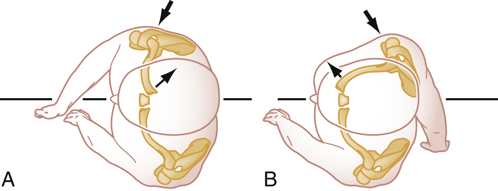 The set of Two Illustrations A and B show how compression forces cause sternoclavicular joint displacements. A leads to posterior, B to anterior displacement of the clavicle's medial end. The set of Two Illustration A and B shows the mechanisms of posterior and anterior displacements of the sternoclavicular joint. A shows a superior view of the shoulder and torso, showing a compression force (upper black arrow) applied to the posterolateral aspect of the shoulder, which results in the posterior displacement of the medial end of the clavicle (lower black arrow). B, also a superior view, shows a lateral compression force (upper black arrow) directed from the anterior position, leading to the anterior displacement of the medial end of the clavicle (lower black arrow).