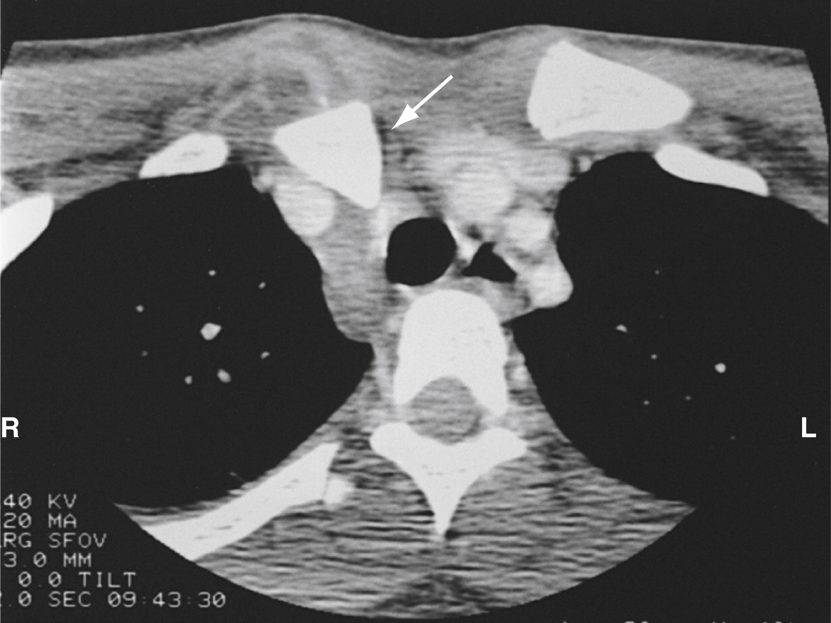 The CT scan shows a posterior dislocation of the right sternoclavicular joint (SCJ). An arrow points to the dislocated joint, which appears to be displaced backward.