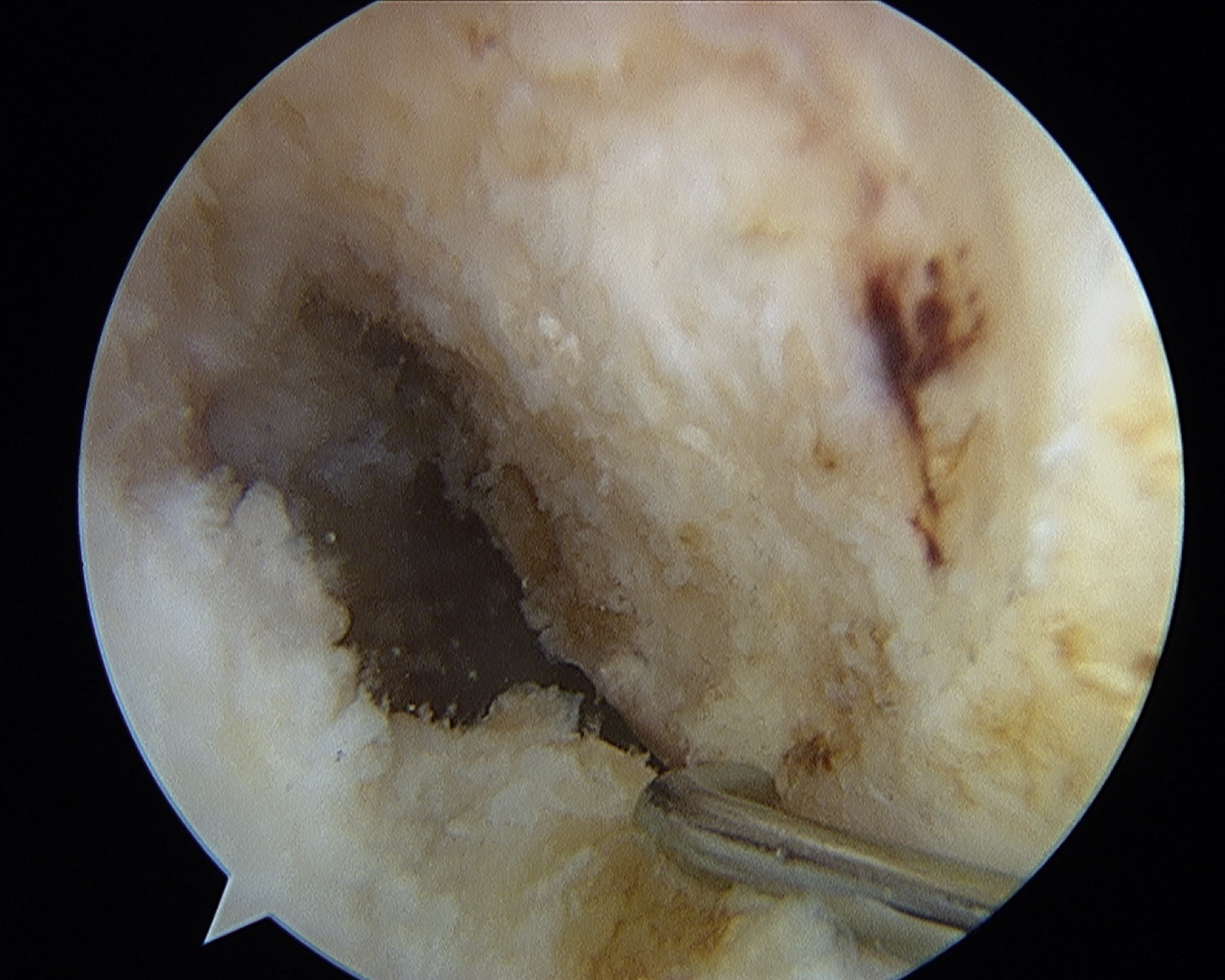 The arthroscopic view shows femoral notch with probe, faint lateral intercondylar ridge, and ACL remnants, aiding height and depth assessment for tunnel placement. The arthroscopic view from the medial portal shows the interior of the femoral notch, with a surgical probe pointing toward bony surfaces. The lateral intercondylar ridge and remnants of the anterior cruciate ligament are faintly visible, though difficult to distinguish. The perspective provides visual assessment of notch height and depth, aiding orientation for accurate femoral tunnel placement during reconstruction surgery.