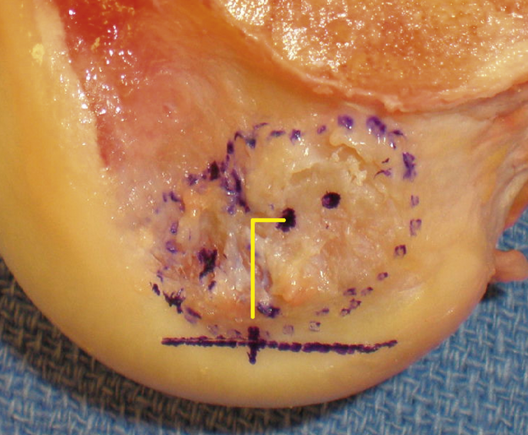 The photograph shows the ACL footprint, yellow line for measurement path, and blue dots marking ACL, anteromedial, and posterolateral bundle centers. The photograph shows the femoral footprint outlined with purple ink markings. The low point of the lateral wall is identified, and a yellow L-shaped line shows a measurement path-8.5 mm upward along the lateral wall and 2.0 mm deeper to locate the anterior cruciate ligament center. Blue ink dots mark the centers of the ACL, anteromedial bundle, and posterolateral bundle, providing anatomical reference points for tunnel placement in reconstruction procedures.