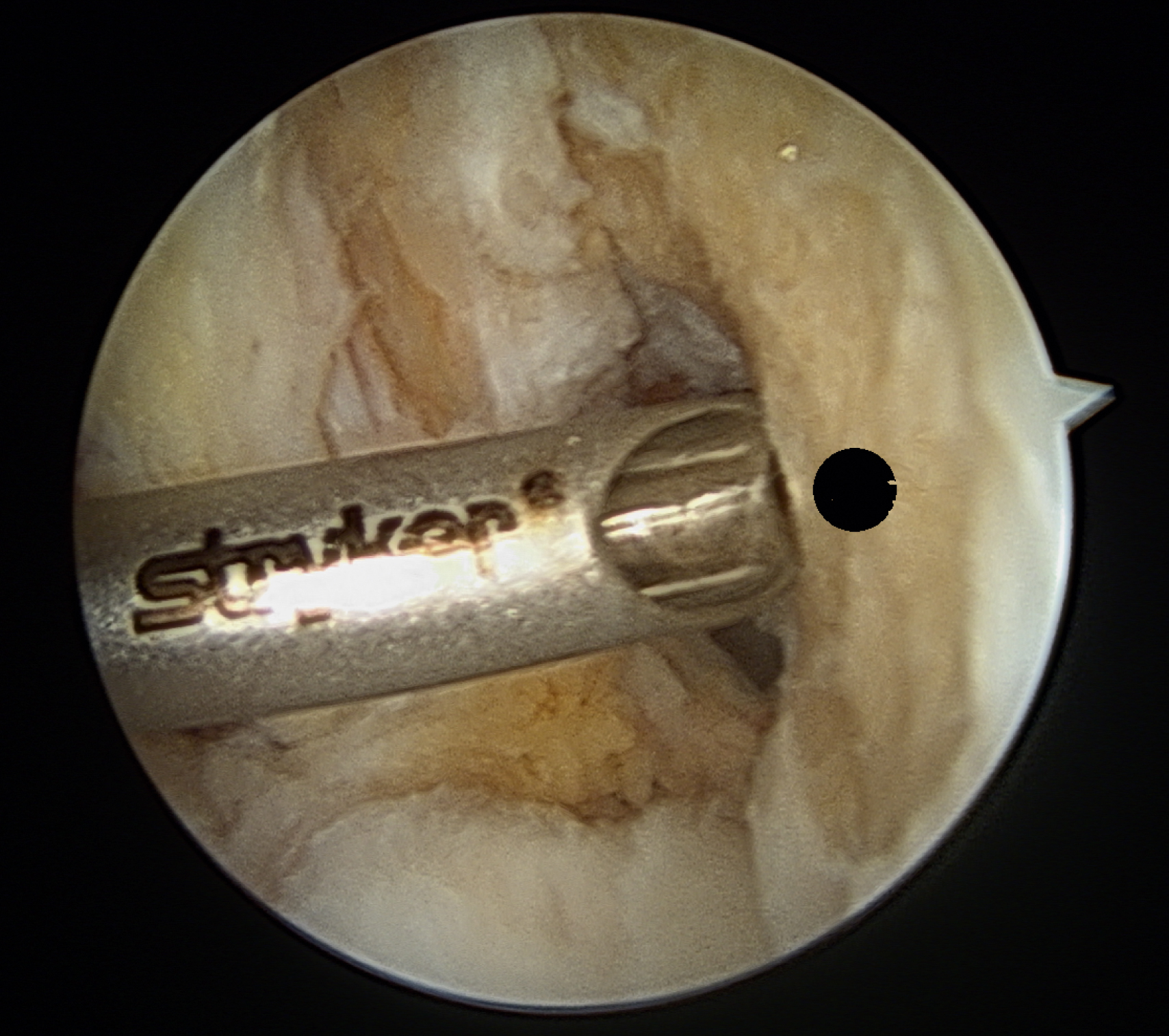 The arthroscopic view shows aimer through medial portal, 7 mm offset and 8.5 mm high from posterior condyle, with black dot marking ACL center for femoral tunnel placement. The arthroscopic view shows a surgical aimer introduced through the medial portal of a knee, positioned with its flange posterior to the condyle. The aimer is aligned to a point 8.5 mm above and 7 mm offset from the posterior condylar surface with the knee flexed at 90 degrees. A black dot marks the precise center of the anterior cruciate ligament, providing a visual landmark for accurate femoral tunnel placement during reconstruction.