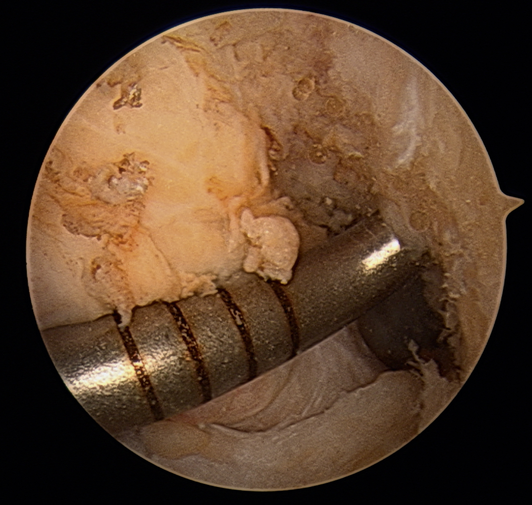 The arthroscopic view shows the medial portal of a knee joint, positioned against the femoral surface to create a pilot hole the predetermined location for anterior cruciate ligament reconstruction.