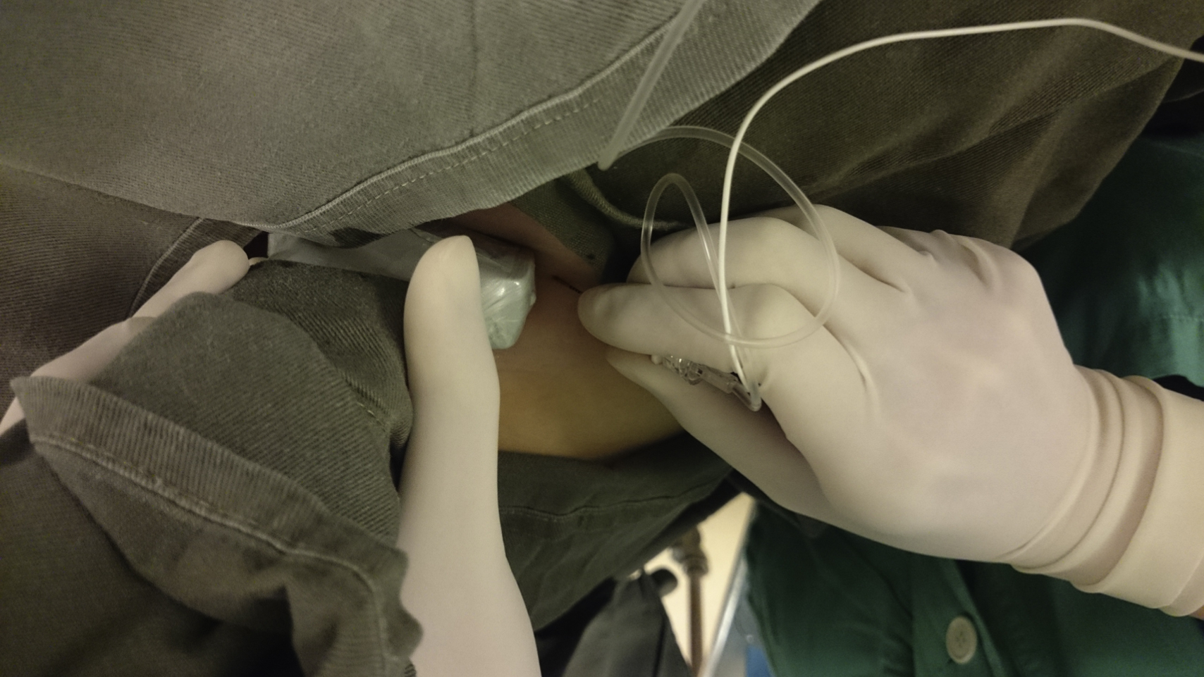 The photograph shows a healthcare performs left femoral nerve block using ultrasound and nerve stimulator guidance, with transducer on thigh and needle inserted just below for precise targeting. The photograph shows a healthcare provider performing a femoral nerve block on the left thigh using ultrasound and peripheral nerve stimulation guidance. The provider holds an ultrasound transducer against the patient's upper thigh to visualize the femoral nerve region, while simultaneously inserting a needle just below the transducer. The patient's leg is draped, and sterile technique is maintained with gloved hands.