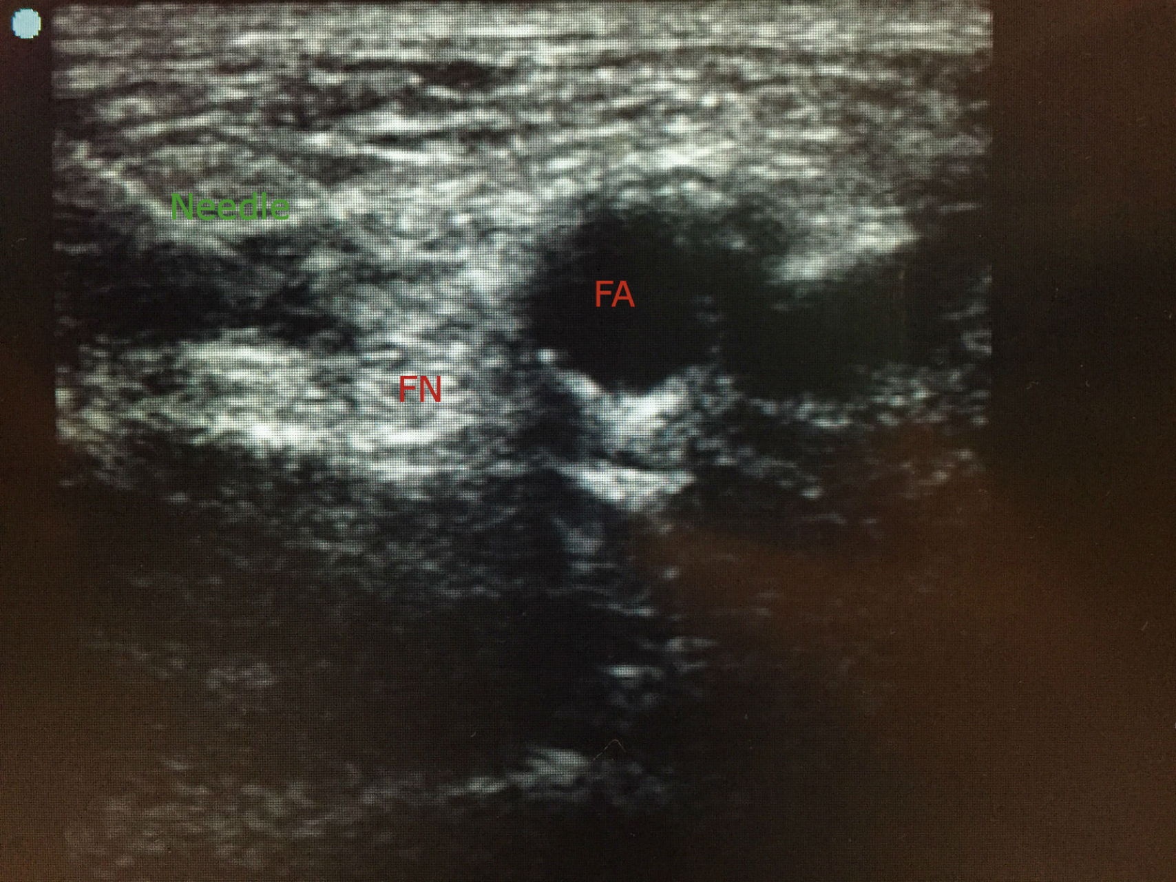 The ultrasound shows the needle advancing toward femoral nerve labeled FN, with femoral artery labeled FA nearby. Blue dot indicates lateral side for orientation. The ultrasound shows the anatomical structures relevant to a femoral nerve block. The needle path is visible entering from the left side of the image toward the femoral nerve, labeled FN. The femoral artery, labeled FA, appears as a circular anechoic (dark) structure medial to the femoral nerve. A blue dot in the upper left corner of the screen shows the lateral side of the showing for orientation.