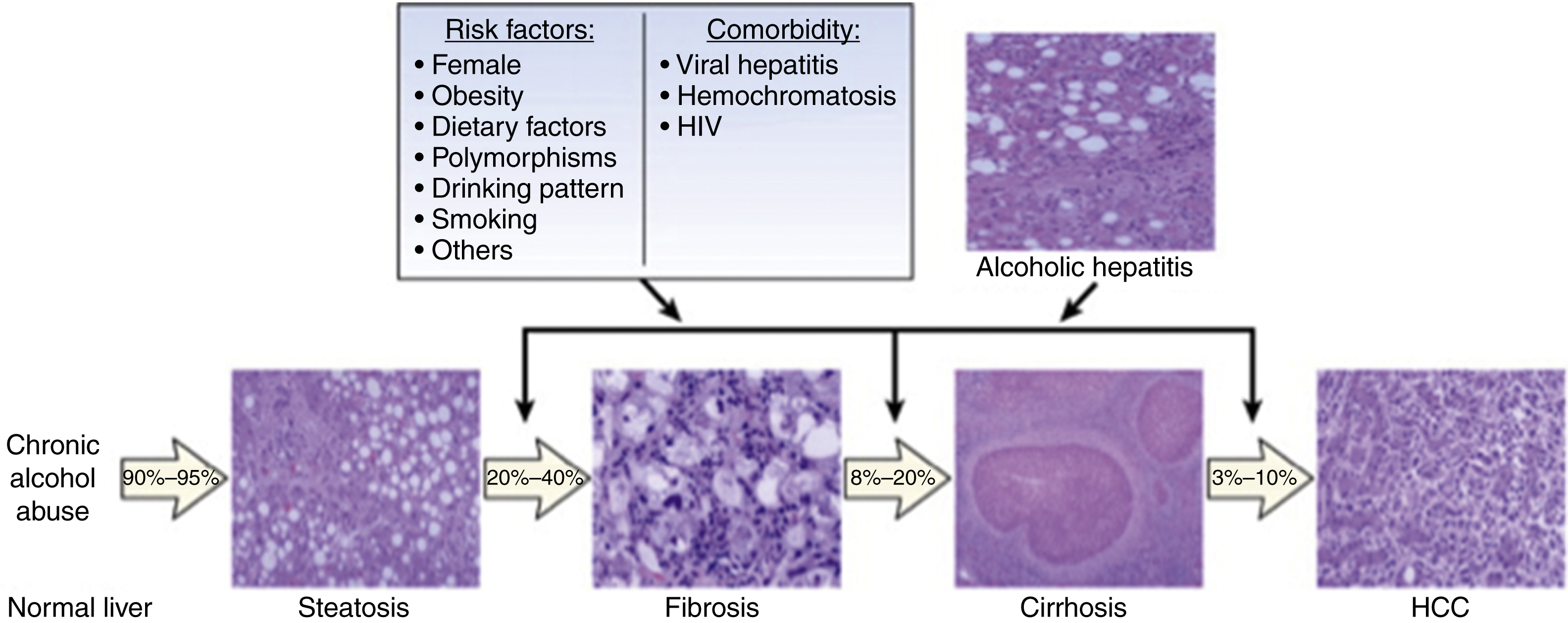 The diagram shows the alcoholic liver disease: normal liver with chronic alcohol use progresses to steatosis, fibrosis, cirrhosis, and HCC. Shows alcoholic hepatitis, risk factors, and histology. The diagram shows the progression of alcoholic-related liver disease with histological examples and associated risk factors. It begins with a “Normal liver” exposed to “Chronic alcohol abuse,” which in 90%–95% of cases progresses to “Steatosis” (fatty liver). From steatosis, 20%–40% develop “Fibrosis,” followed by 8%–20% progressing to “Cirrhosis,” and finally 3%–10% advancing to “HCC” (hepatocellular carcinoma). A separate pathway shows “Alcoholic hepatitis” as an acute manifestation. A risk factor box lists “Female,” “Obesity,” “Dietary factors,” “Polymorphisms,” “Drinking pattern,” “Smoking,” and “Others.” Another box labeled “Comorbidity” includes “Viral hepatitis,” “Hemochromatosis,” and “HIV.” Each disease stage is represented with a histology slide showing tissue changes.
