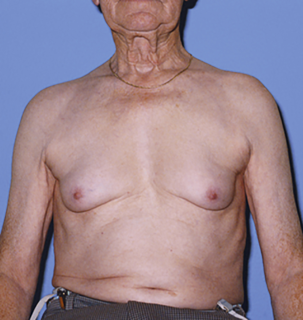 The photograph shows an older male patient with cirrhosis presenting with gynecomastia. There is bilateral enlargement of breast tissue, more pronounced around the nipples, with visible chest muscle.