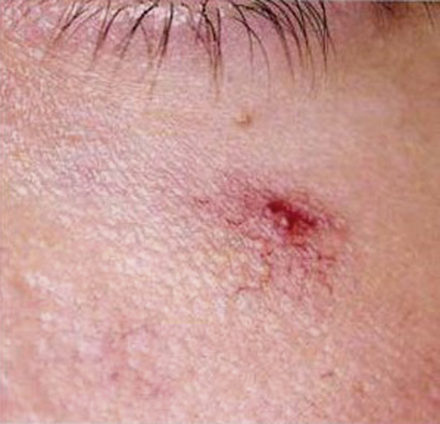 The photograph shows a close-up of facial skin, a red lesion with a central punctum (arteriole) and radiating thin vessels, typical of a spider nevus, on a light skin background.