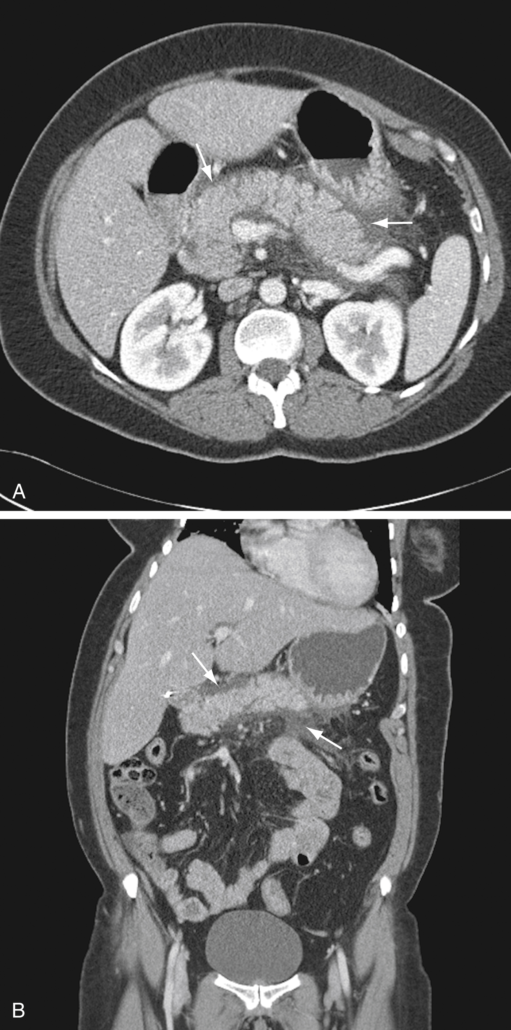 A set of two CT scan shows axial view (A) and coronal view (B) show pancreas with arrows shows mild peripancreatic fluid and fat stranding, with kidneys, bowel loops, and liver visible. A set of two CT scan shows the abdomen. The top labeled “A” is an axial view, and the bottom labeled “B” is a coronal view. Both are show the pancreas with arrows pointing to mild peripancreatic fluid and surrounding fat stranding, indicative of acute interstitial pancreatitis. Other abdominal organs with kidneys, bowel loops, and liver are visible for anatomical orientation.