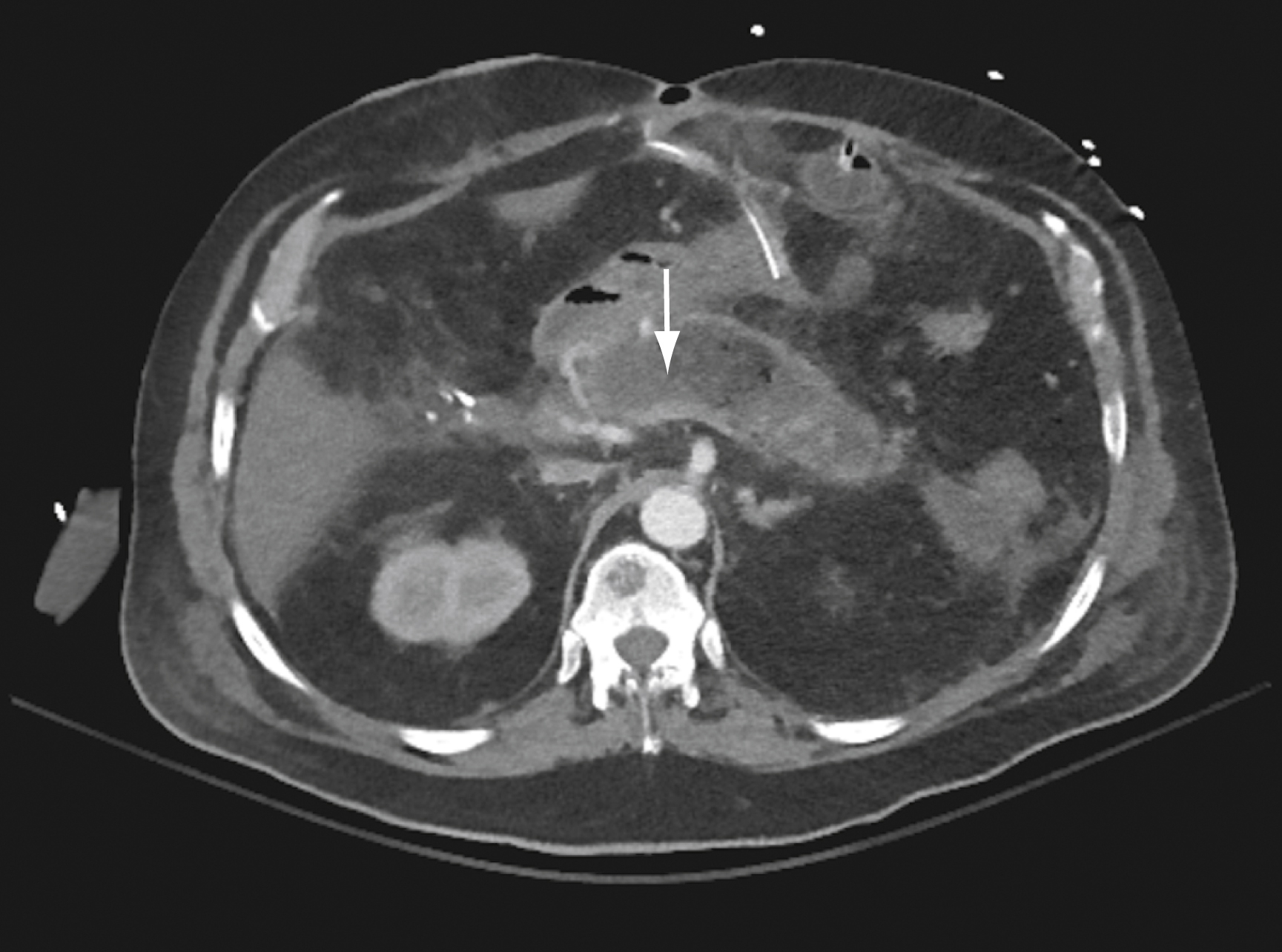 The CT scan shows axial view of the abdomen pancreas with arrow pointing to decreased enhancement and necrotic fluid replacing parenchyma, with liver, stomach, bowel loops, and spine visible. The CT scan shows axial view of the abdomen with the pancreas visible in the center. An arrow points to an area of decreased enhancement within the pancreas where the parenchyma is replaced by necrotic fluid. Surrounding abdominal structures, including portions of the liver, stomach, bowel loops, and spine, are visible for anatomical orientation.