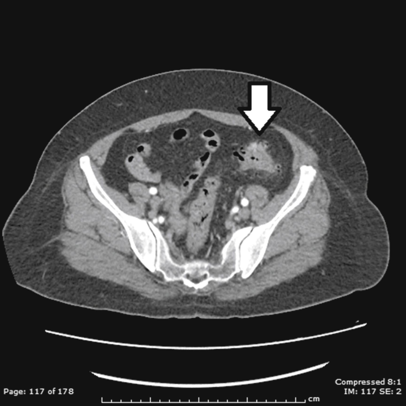 The CT scan shows abdomen diverticulitis with arrow pointing to air-filled diverticuli along the left colon and hazy bowel border with fat stranding, shows localized inflammation. The CT scan shows the abdomen uncomplicated diverticulitis, shows by a bold arrow pointing to multiple air-filled structures along the edge of the left colon, representing diverticuli. There is a hazy outer border of the bowel segment consistent with fat stranding, with localized inflammation. Surrounding abdominal organs and soft tissue structures are also visible for orientation.