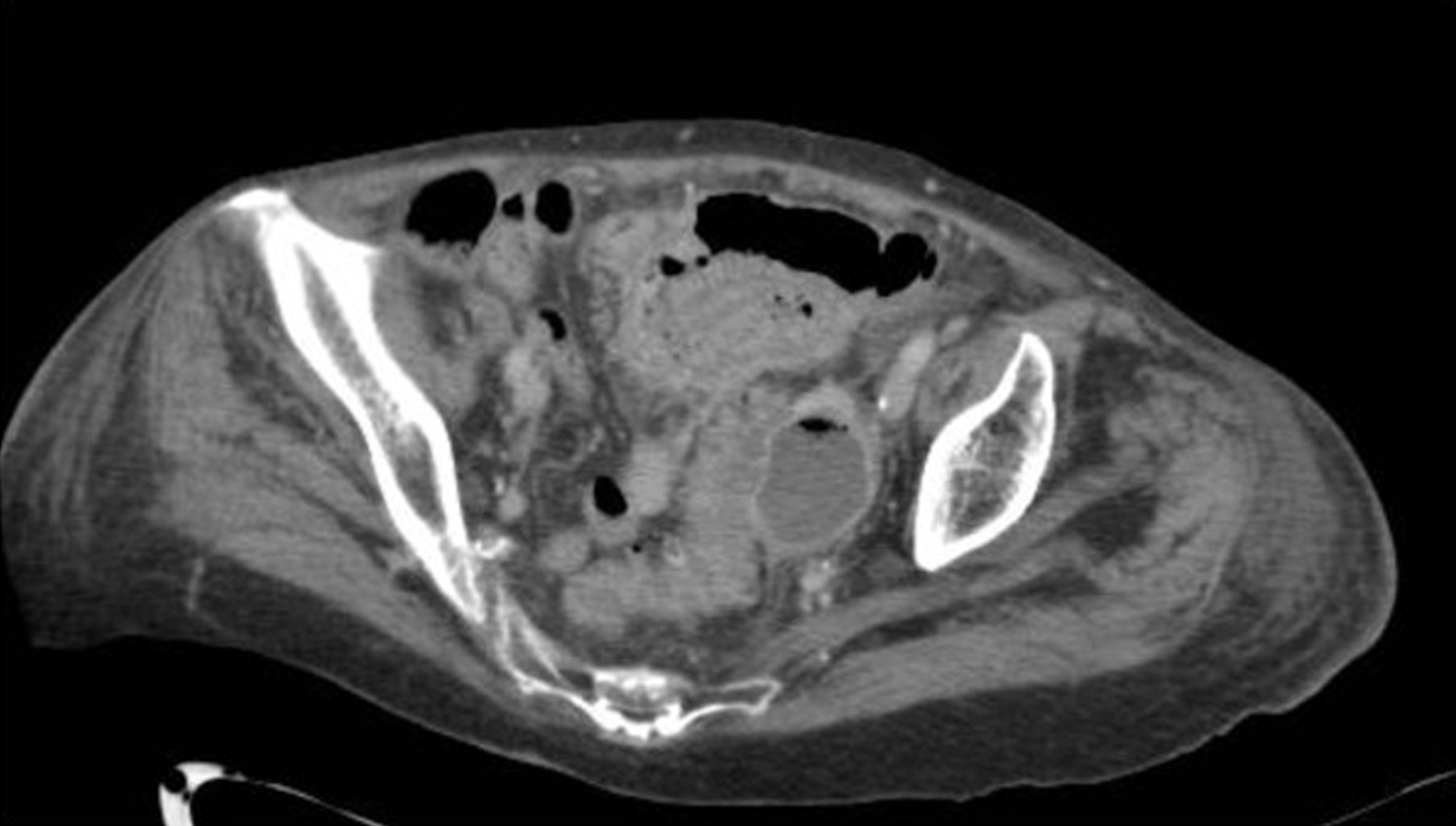 The CT scan shows abdomen left colon diverticulitis with abscess formation, bowel wall thickening, adjacent fluid collection, and surrounding fat stranding shows inflammatory changes. The CT scan shows abdomen diverticulitis with abscess formation in the left colon. The bowel wall appears thickened, and there is evidence of a localized fluid collection adjacent to the affected colon segment. Surrounding fat stranding is visible, shows inflammatory changes, and other abdominal organs and bowel loops are present for anatomical context.