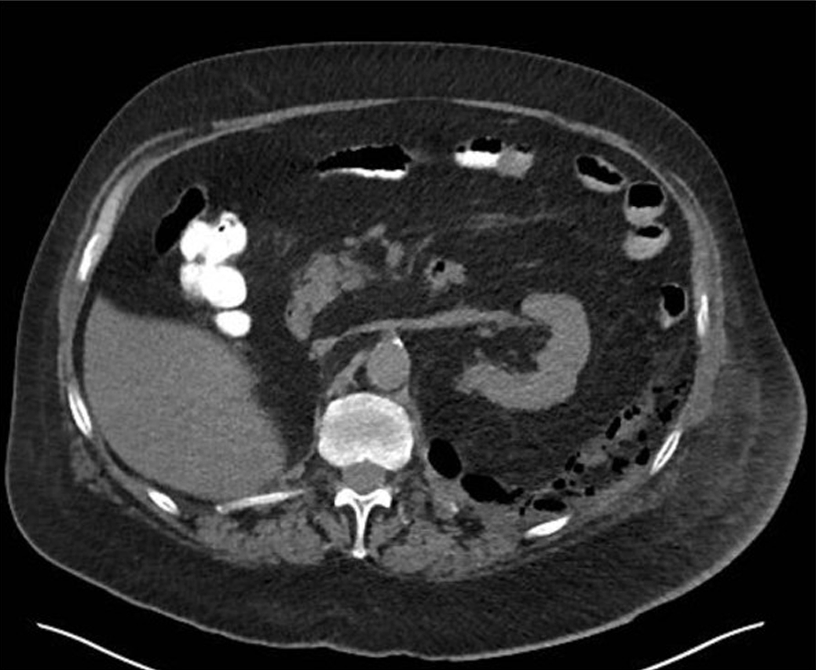 The CT scan shows abdomen diverticulitis with perforation, seen as free air outside the bowel lumen, thickened colon wall, and surrounding mesenteric fat stranding shows inflammation. The CT scan of the abdomen shows diverticulitis with evidence of free air formation, shows perforation. The affected colon segment shows wall thickening, and adjacent mesenteric fat stranding is visible. Multiple small air pockets are seen outside the bowel lumen, consistent with extraluminal free air. Other abdominal organs and bowel loops are visible for orientation.