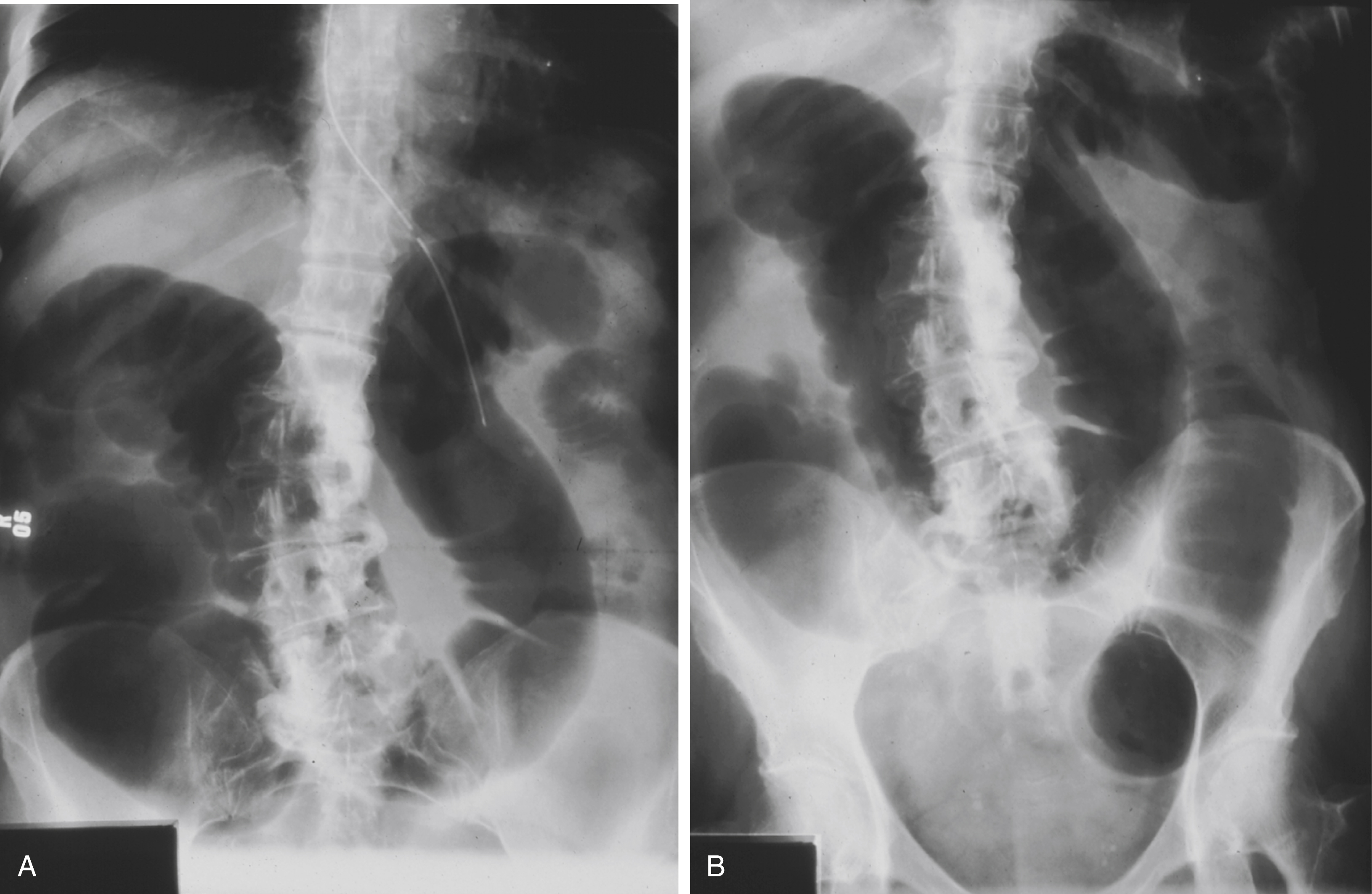 A set of two radiograph show abdominal, upright view (A) shows dilated bowel loops with air-fluid levels; supine view (B) shows diffuse colonic dilation, shows sigmoid colon obstruction. A set of two radiograph show abdominal demonstrating large bowel obstruction at the sigmoid colon. The left labeled A is an upright view shows multiple dilated bowel loops and air-fluid levels. The right labeled B is a supine view shows diffuse colonic dilation with prominent gas-filled loops. Both views shows obstructive patterns consistent with blockage at the sigmoid colon.