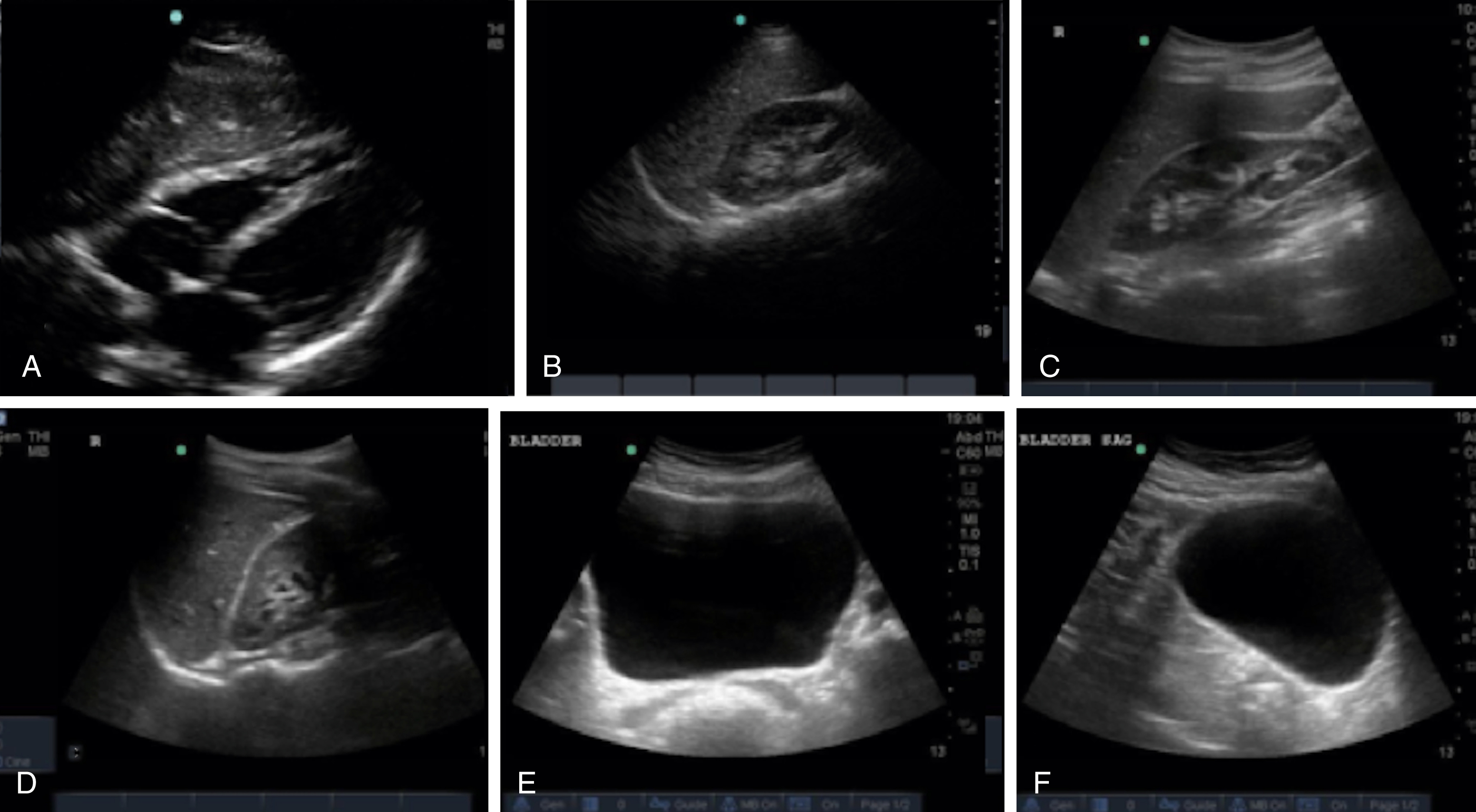 The Ultrasound shows the panels from A-F. Heart normal, RUQ & LUQ views show no thoracic issues, transverse and sagittal bladder scans appear normal, empty, and anechoic, confirming negative FAST. The Ultrasound shows six separate panels, labeled A through F, each displaying a different view of internal organs. Panel A, a subxiphoid view, shows the heart without pericardial effusion, shows a normal cardiac scan. Panel B, (RUQ) view, displays the thoraco-hepatorenal space, specifically noting the absence of paracolic gutter fluid, with visible mirroring and loss of the spine, confirming no thoracic pathology. Panel C, another RUQ view, focuses on the paracolic gutter area near the liver tip, also showing no abnormalities. Panel D presents a left upper quadrant (LUQ) view, similar to B and C, demonstrating a negative thorax and splenorenal space. Panel E is a transverse view of the bladder, appearing normal and empty. Panel F shows a sagittal view of the bladder, also appearing normal and anechoic, consistent with a negative bladder scan.