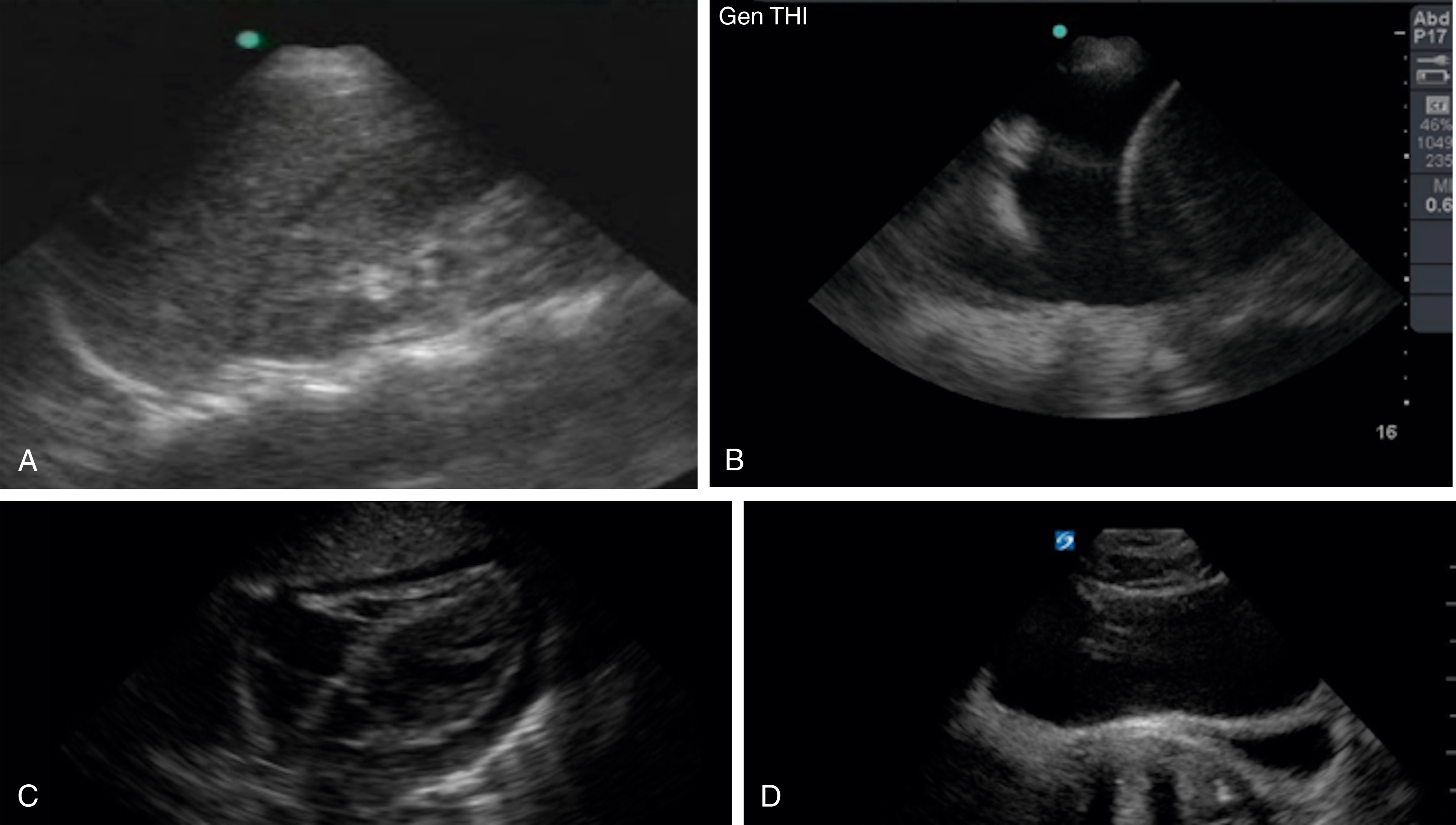 The Ultrasound shows four panels, A,B,C,D. RUQ shows hepatorenal free fluid,LUQ shows splenorenal fluid, subxiphoid view shows pericardial effusion, bladder view shows anterior intraperitoneal fluid. The Ultrasound shows four panels, A,B,C,D. Each showcasing a different positive “FAST” (Focused Assessment with Sonography for Trauma). Panel A shows a right upper quadrant (RUQ) view, revealing a thin anechoic stripe, indicative of free fluid, in the hepatorenal space, while the thorax appears clear with no visible paracolic gutter fluid. Panel B, a left upper quadrant (LUQ) view, shows a significant hemothorax and splenorenal space involvement, characterized by the loss of mirroring and continued visualization of the spine. Panel C, a subxiphoid view of the heart, demonstrates a circumferential pericardial effusion. Panel D depicts a transverse view of the bladder with clear evidence of free fluid located anteriorly to the bladder.