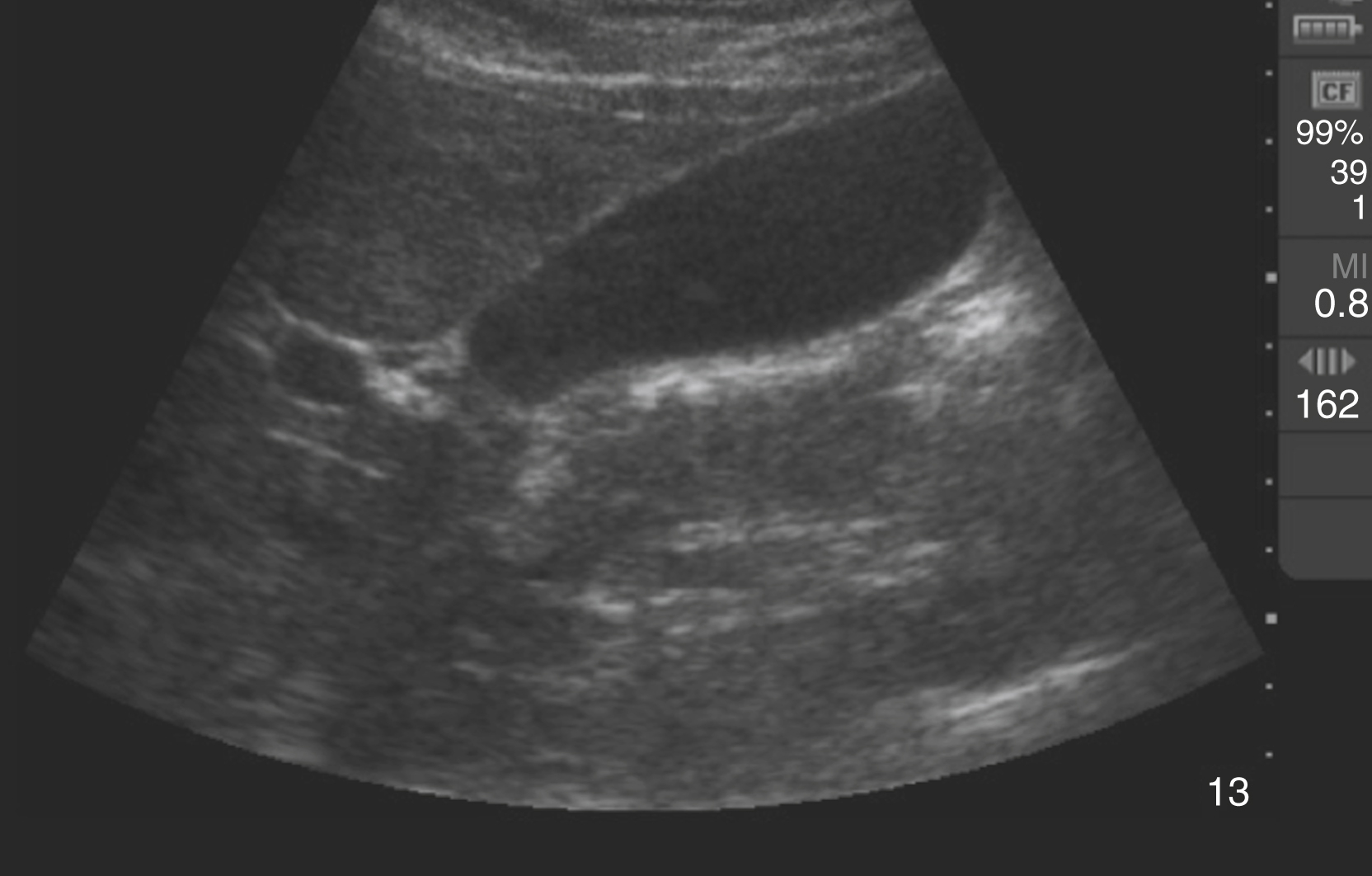 The Ultrasound shows sagittal view of a normal gallbladdera, anechoic, pear-shaped gallbladder with thin walls, no stones, sludge, or pericholecystic fluid, surrounding liver appears homogenous.