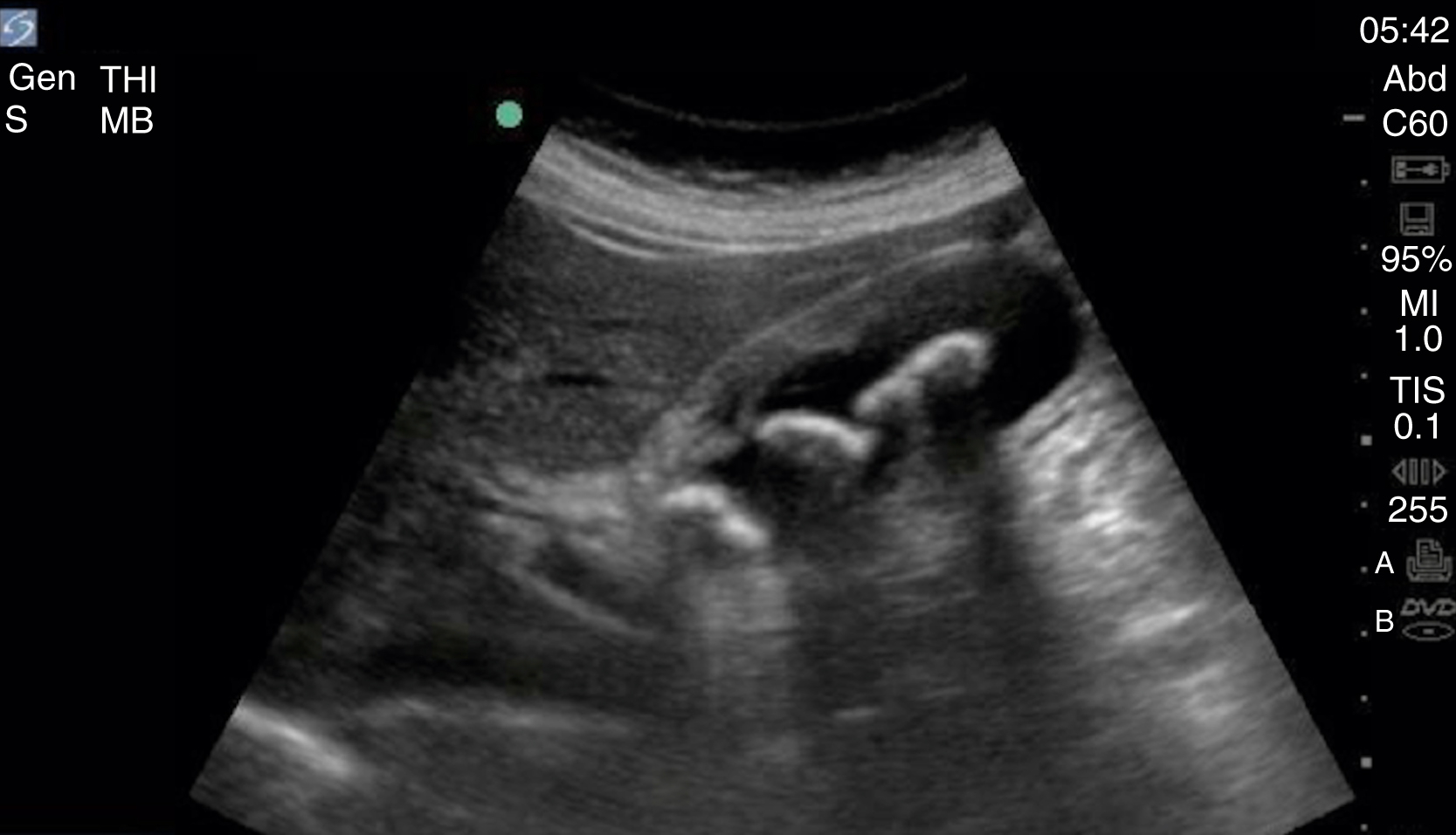 The Ultrasound shows a sagittal view of a gallbladder, thickened inflamed gallbladder wall, and pericholecystic fluid rim—findings consistent with acute cholecystitis. The Ultrasound shows a sagittal view of a gallbladder exhibiting signs of acute cholecystitis. Multiple hyperechoic foci, consistent with gallstones, are visible within the lumen of the gallblader. The anterior wall of the gallbladder appears significantly thickened, showing inflammation. Additionally, there is evidence of pericholecystic fluid, seen as an anechoic rim surrounding the gallbladder wall.